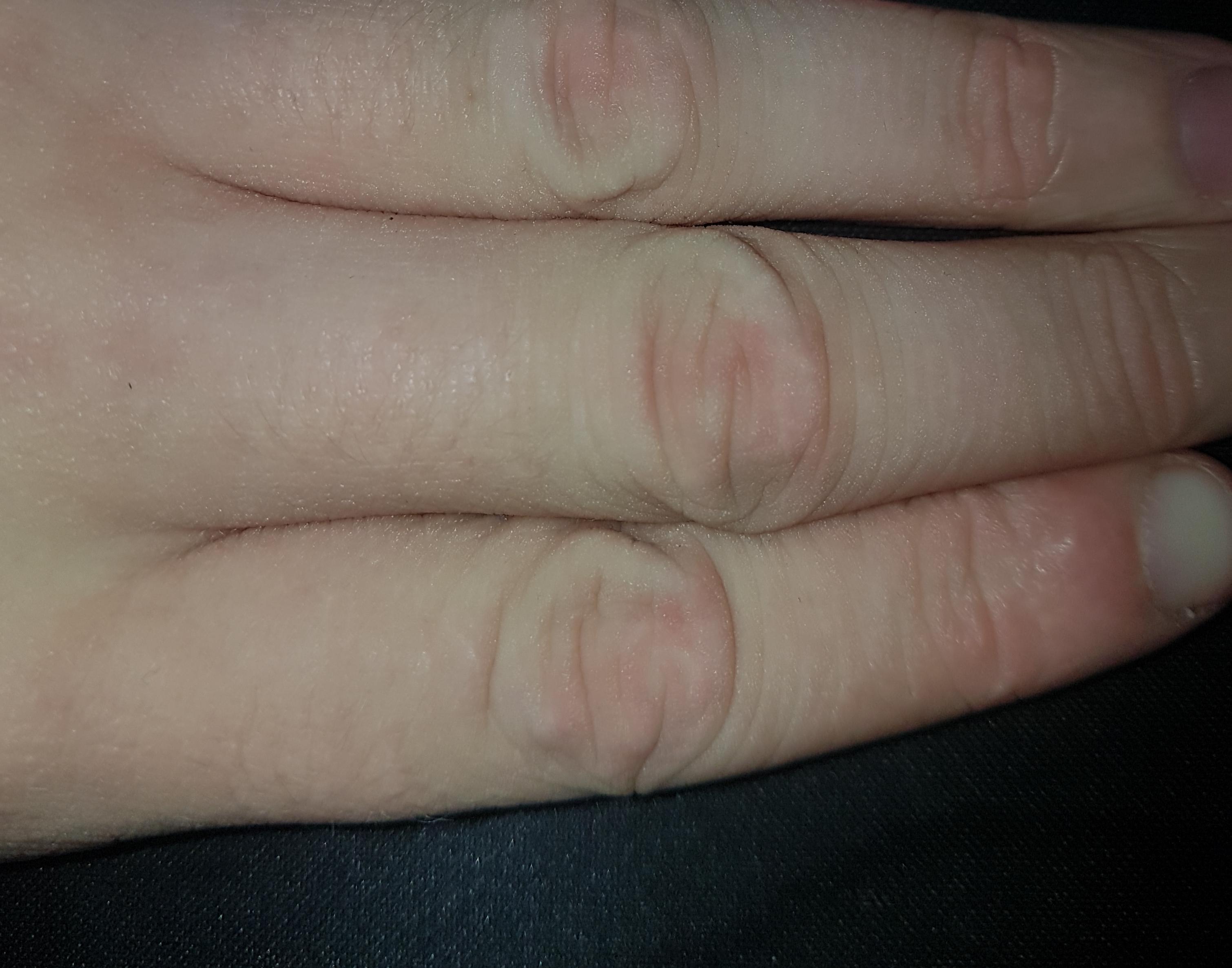 I've had these wrinkles on my fingers (and other parts of my hands