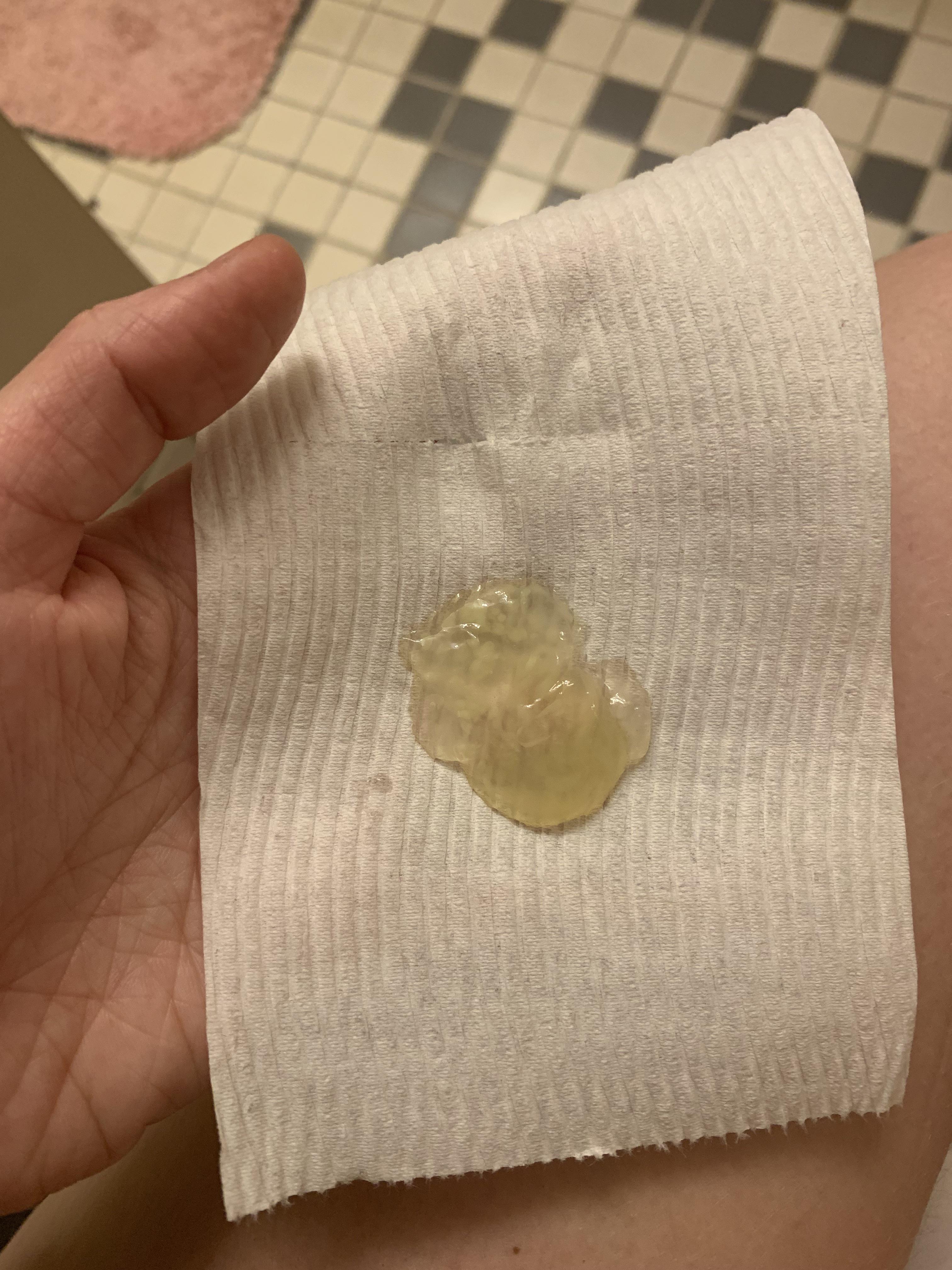 Large Amount of Mucus from Anus : medical_advice