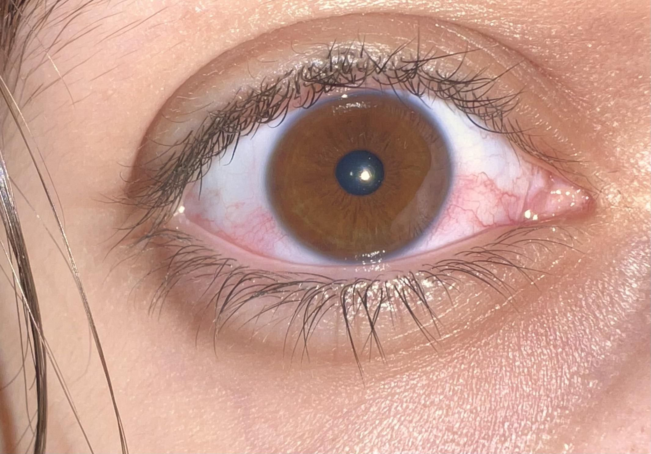 Blue/grey ring around eyes. Is this something to be concerned about? (Ignore eye redness, I