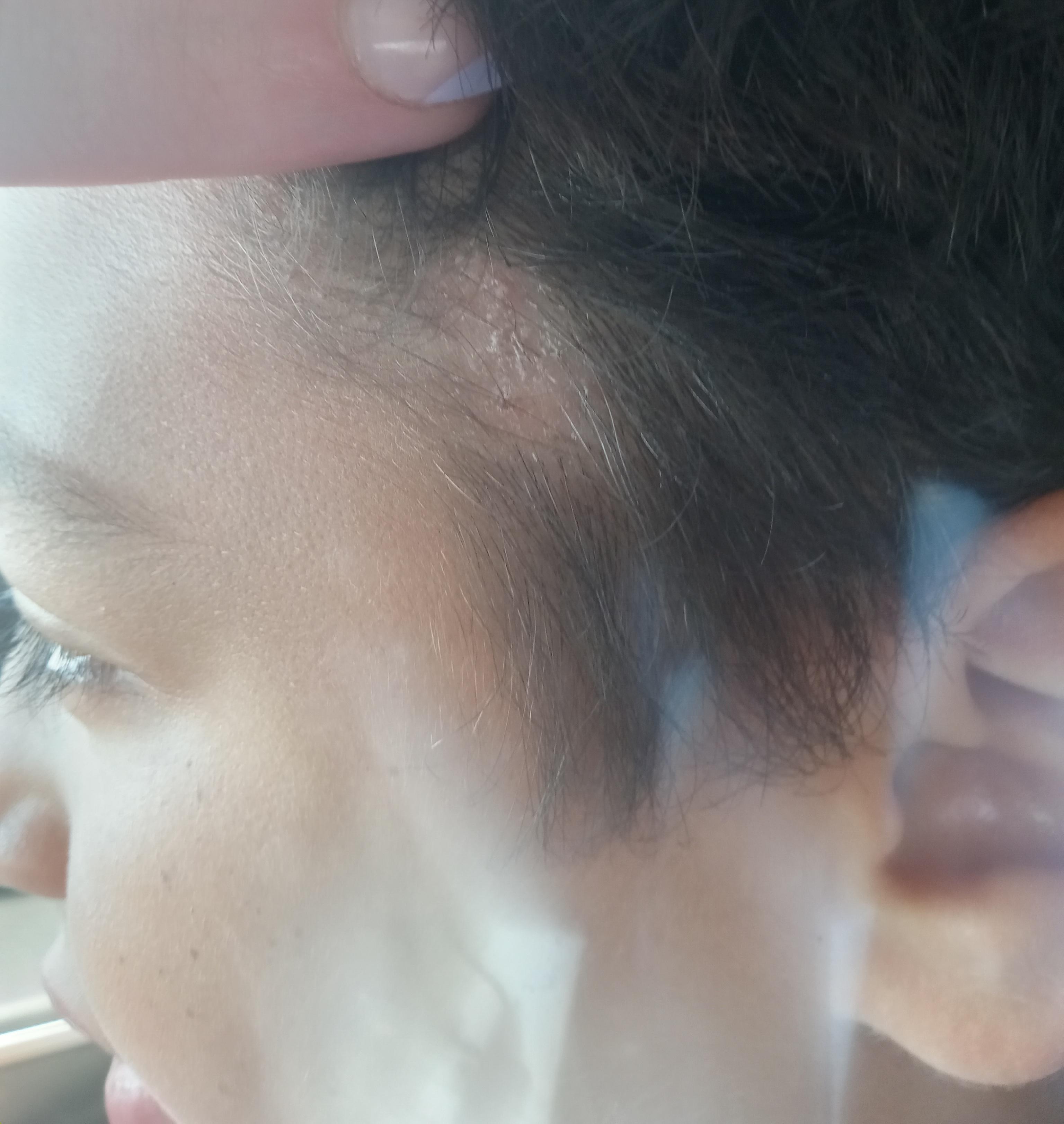 List 104+ Pictures What Does Ringworm Look Like On A Person Sharp