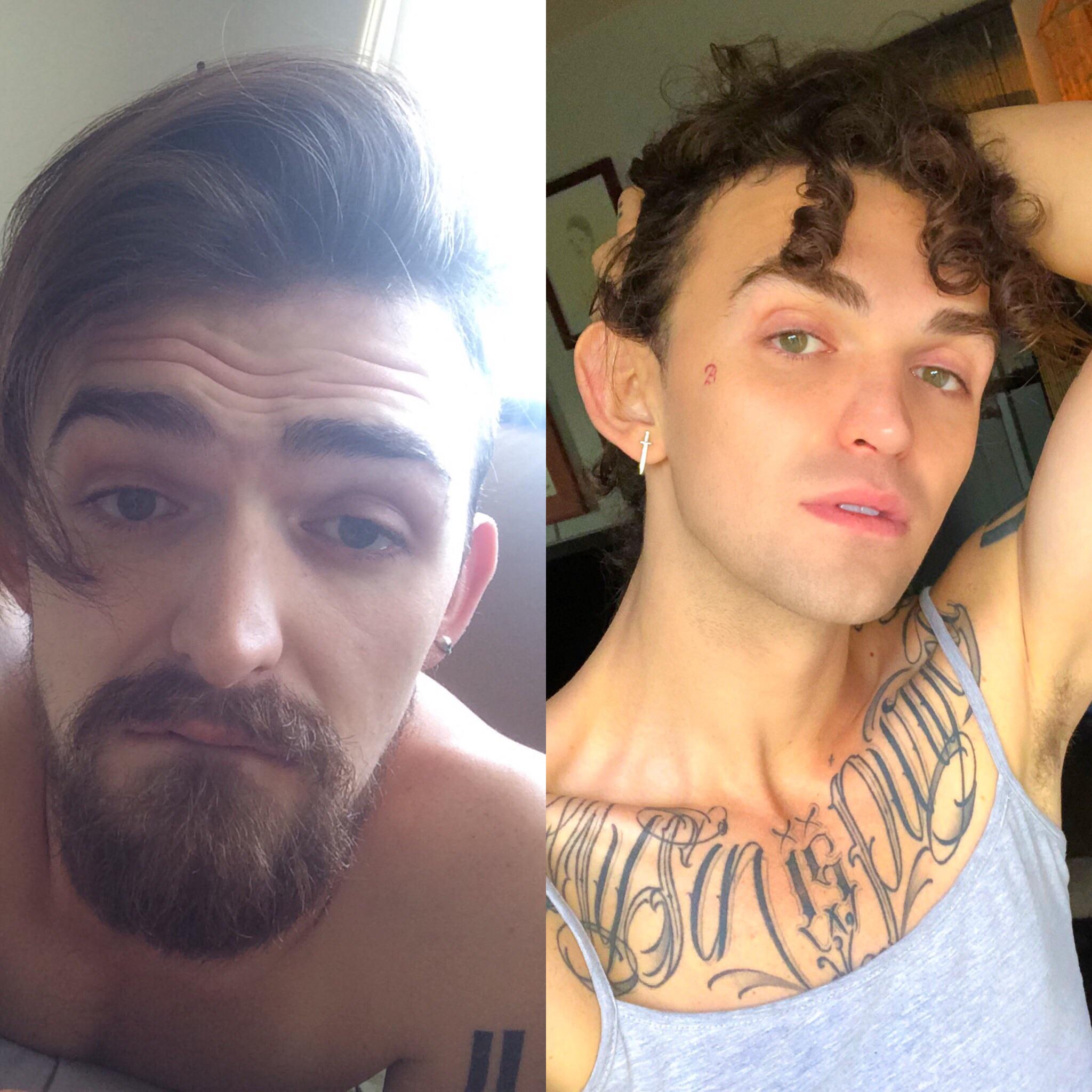 Discover 65+ laser hair removal beard in.eteachers