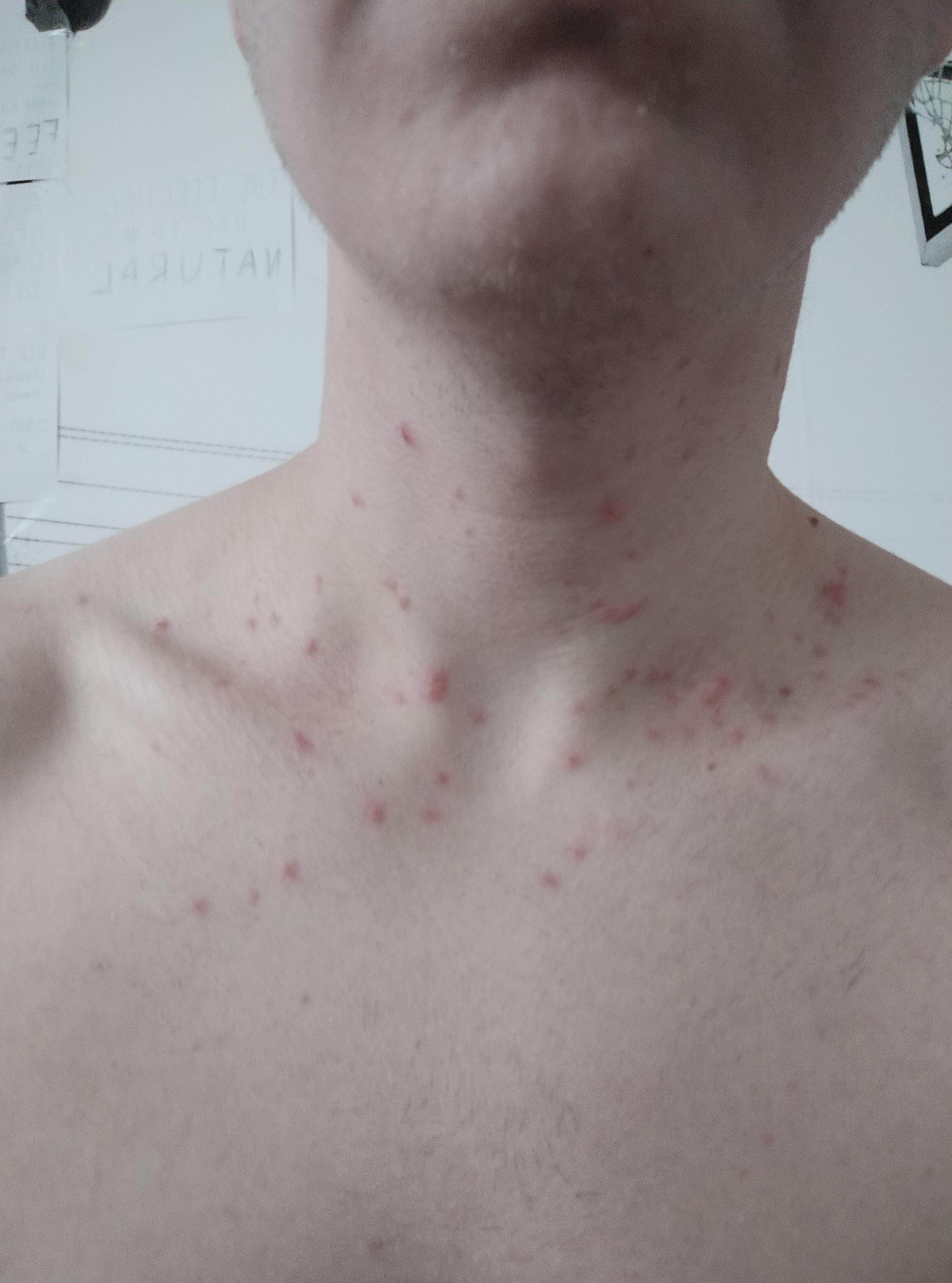 Hello guys, please did anyone experienced this? I have strong acne on