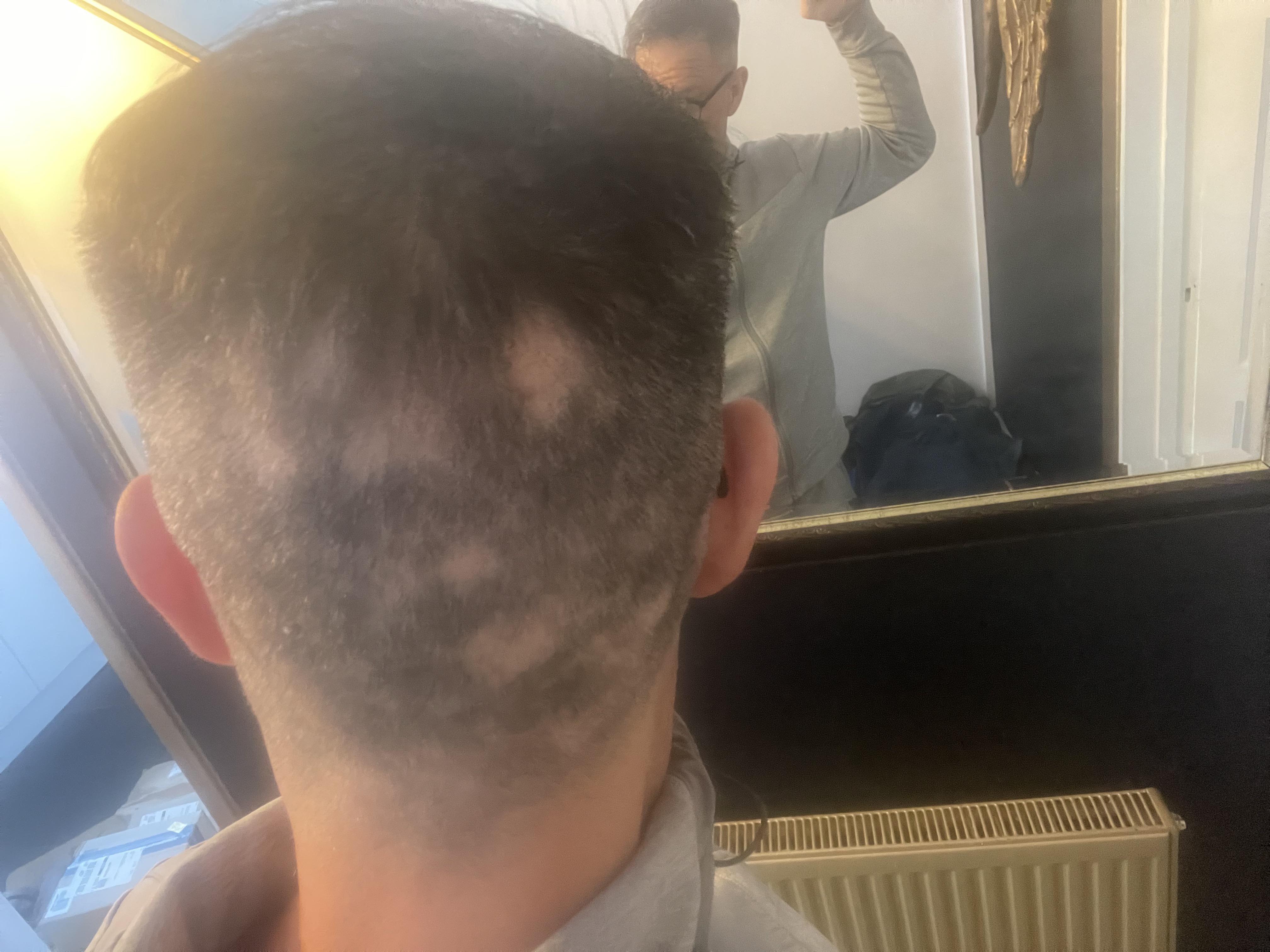 How long does an outbreak normally last ? r/alopecia_areata