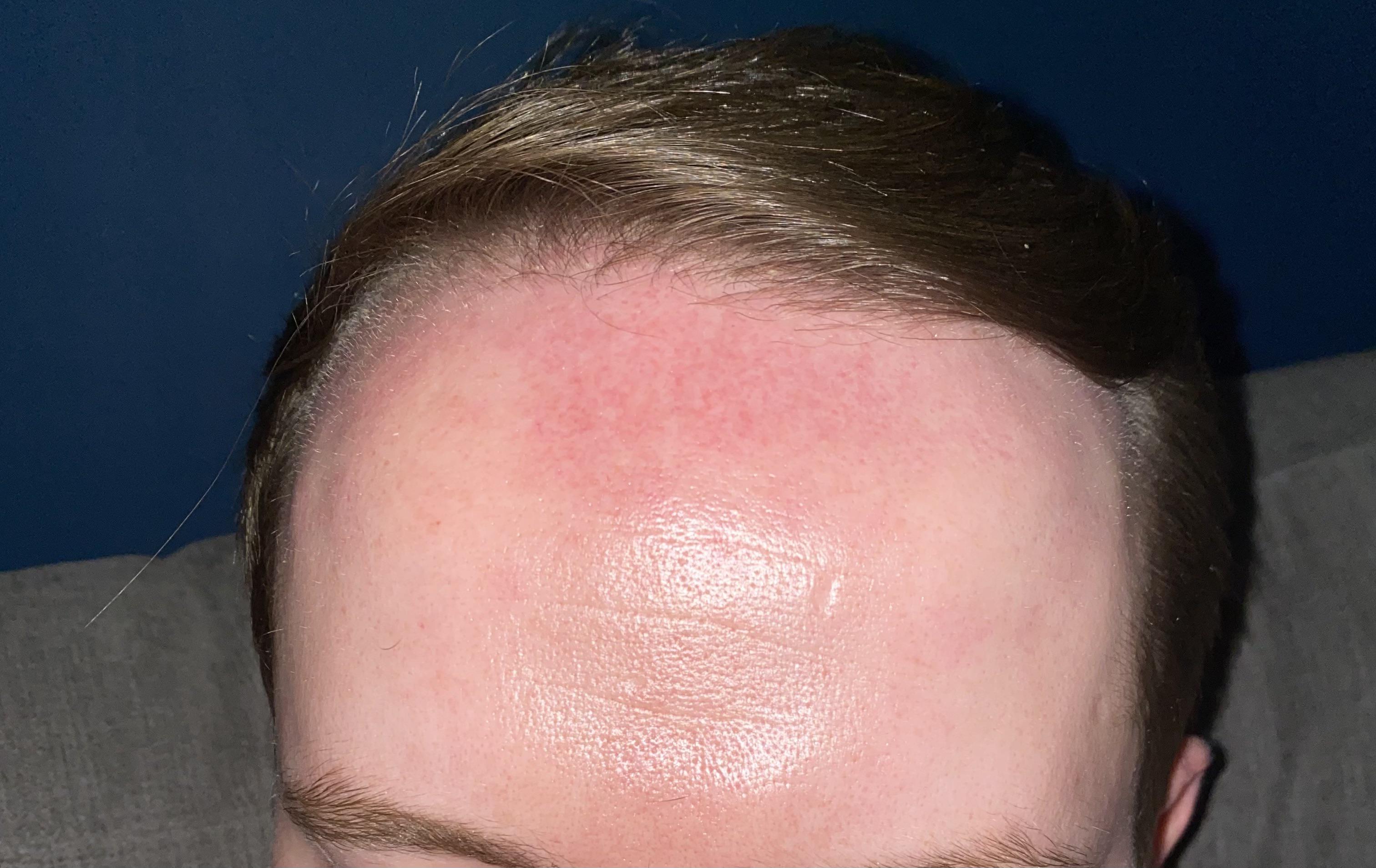 Help please 🙏 Any advice for my forehead redness? r/SkincareAddicts