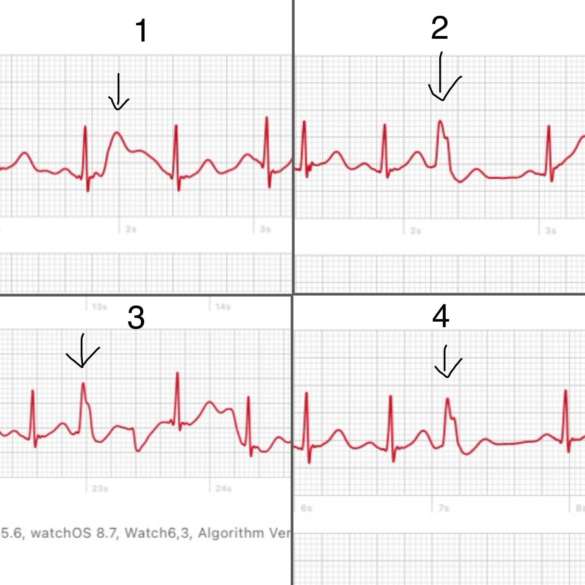 Having flutters in chest and neck, caught these at each palpitation on