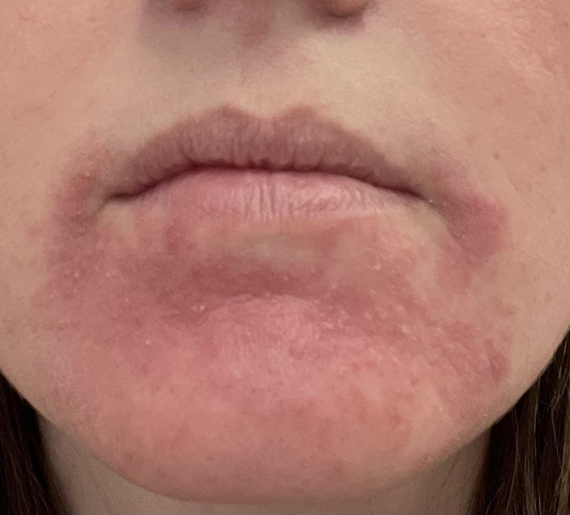 Perioral Dermatitis
