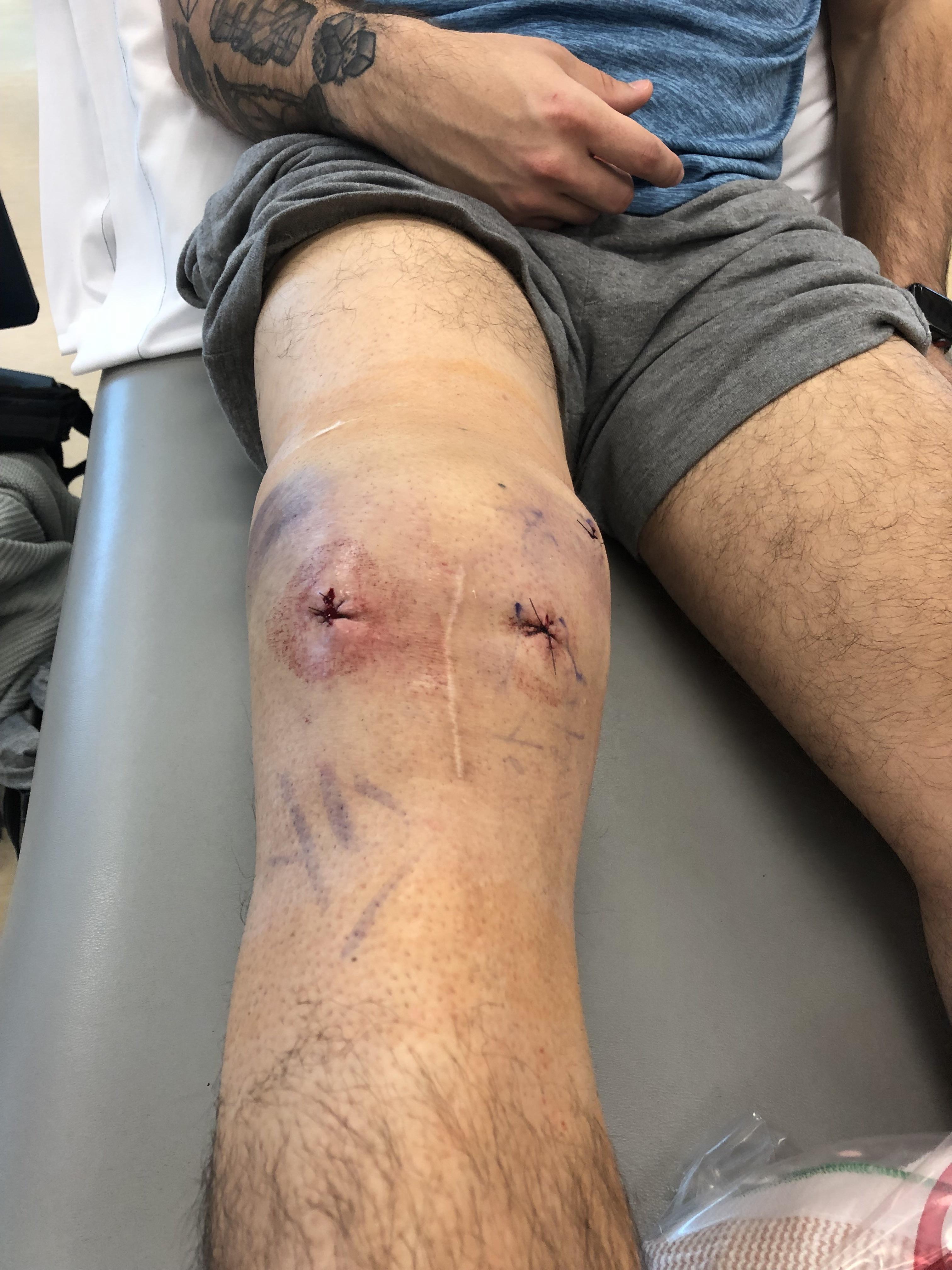 4 hours after my 4th knee surgery in the past 16 months. What a tough