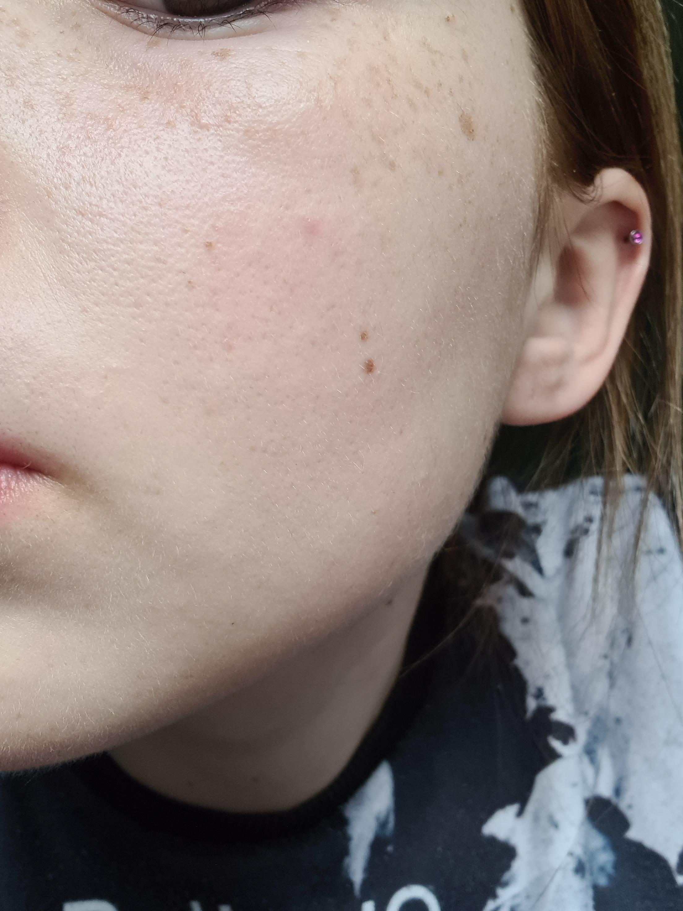 I think i have chemical burn... . I started using the ordinary retinol