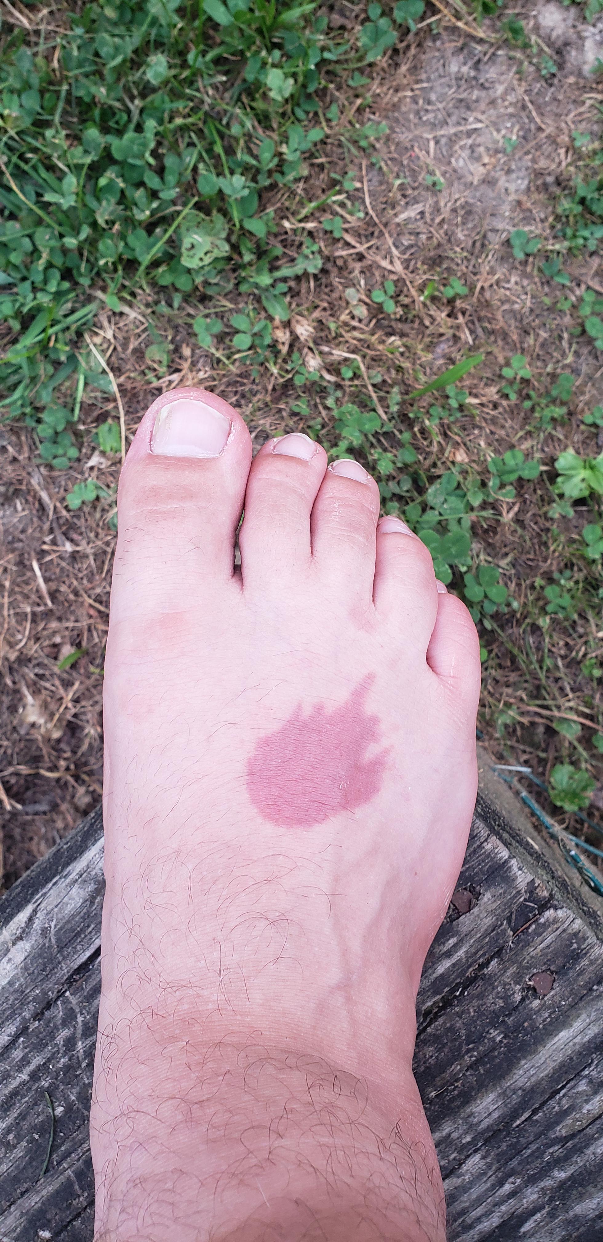 The grease burn on my foot looks like a meteor r/Pareidolia
