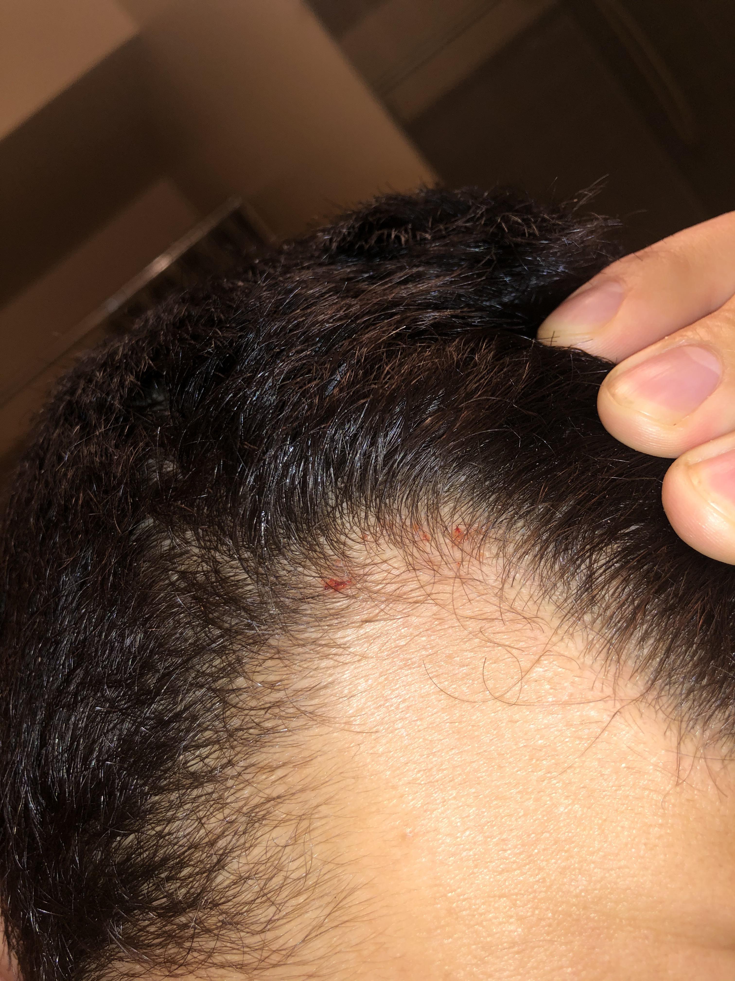Am Losing Hair ? Red Bloody Marks On Scalp , On Rad 20Mg : R/Sarmssourcetalk