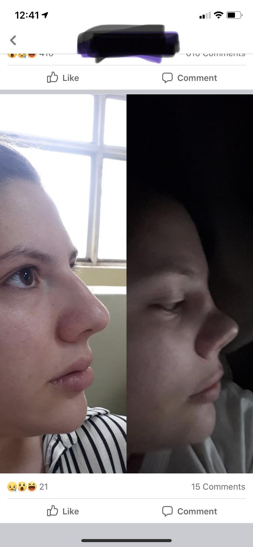 Free nose job in Argentina posted by the girl on a shame me group on FB