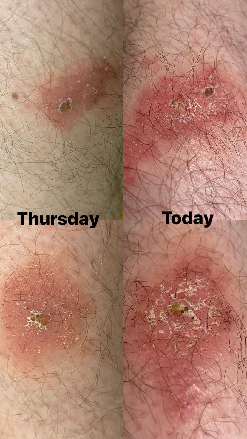 Spider bites? Male/23y and I thought these were any other insect bite