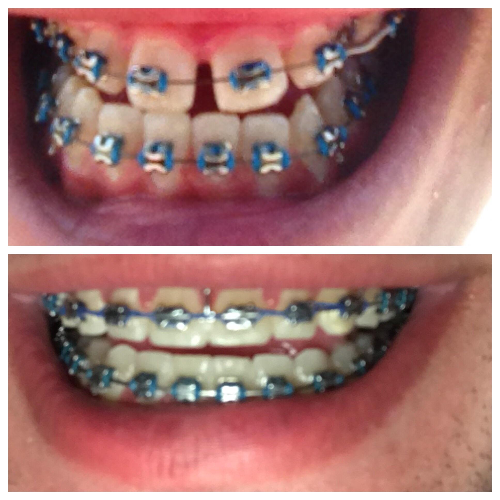 First day of braces (2012) to second to last day of braces (2018) r/pics