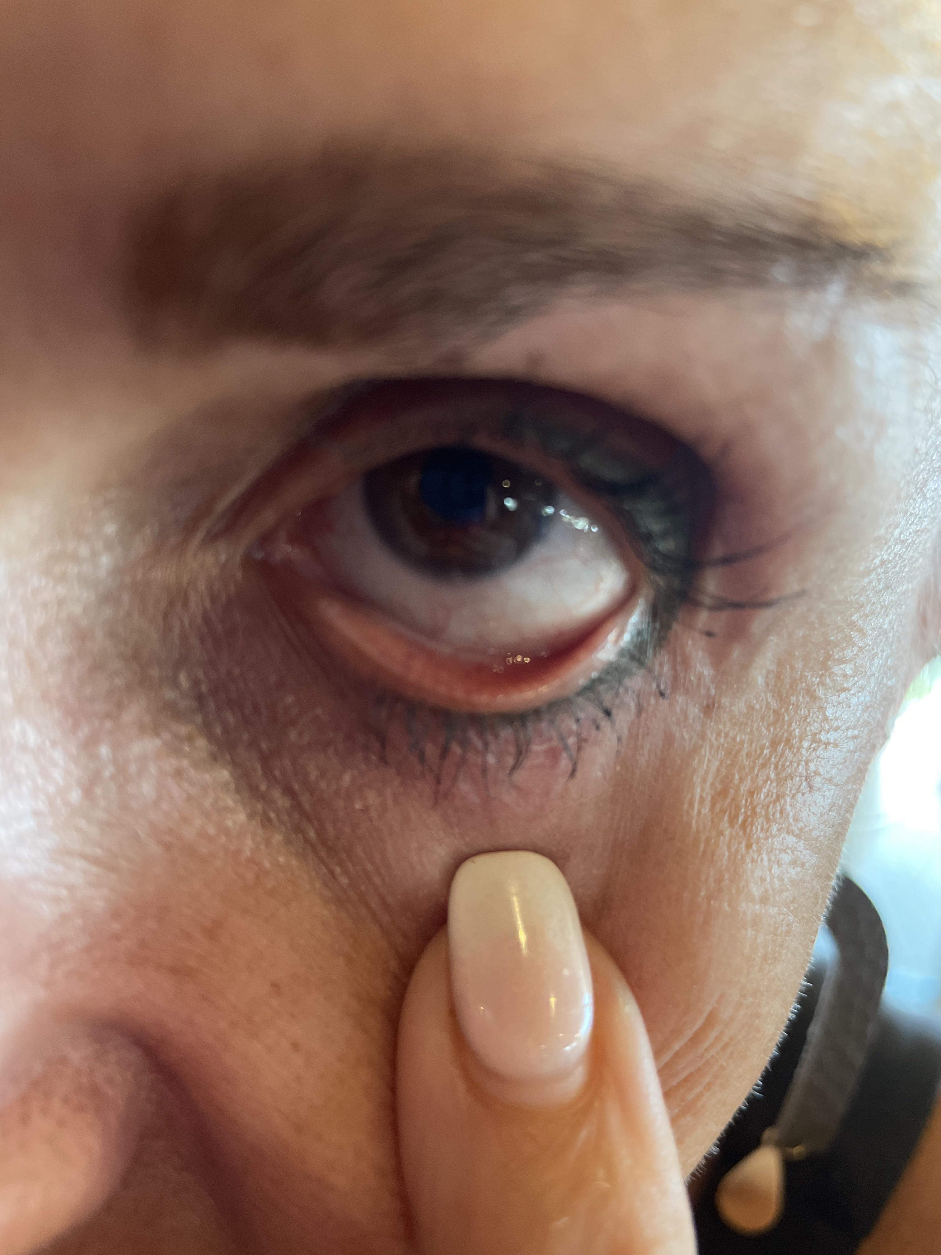 White dot in my eye feels like something is in it? optometry