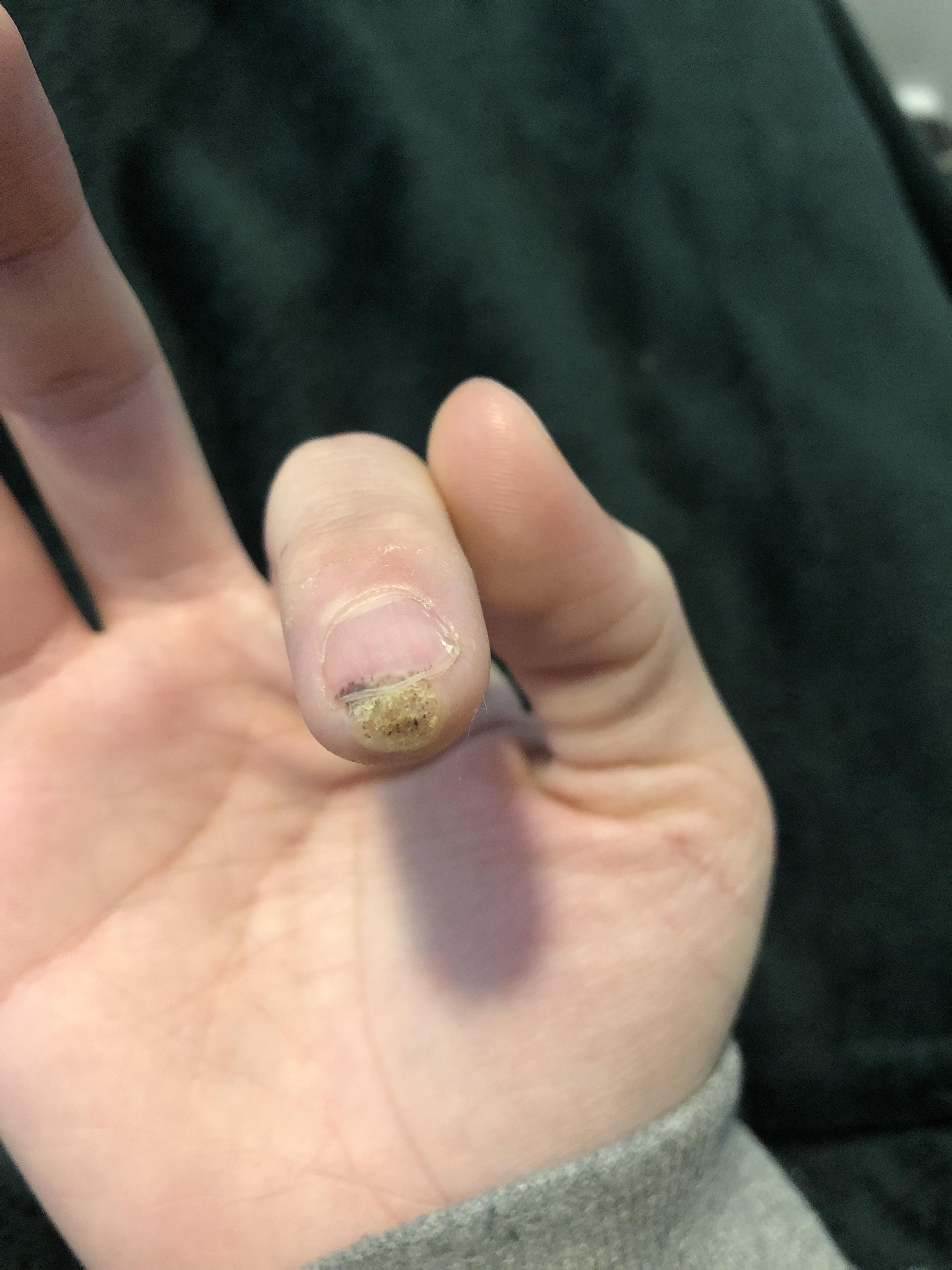 day 2 of ACV on my perungial wart, help me through this pain. The pain