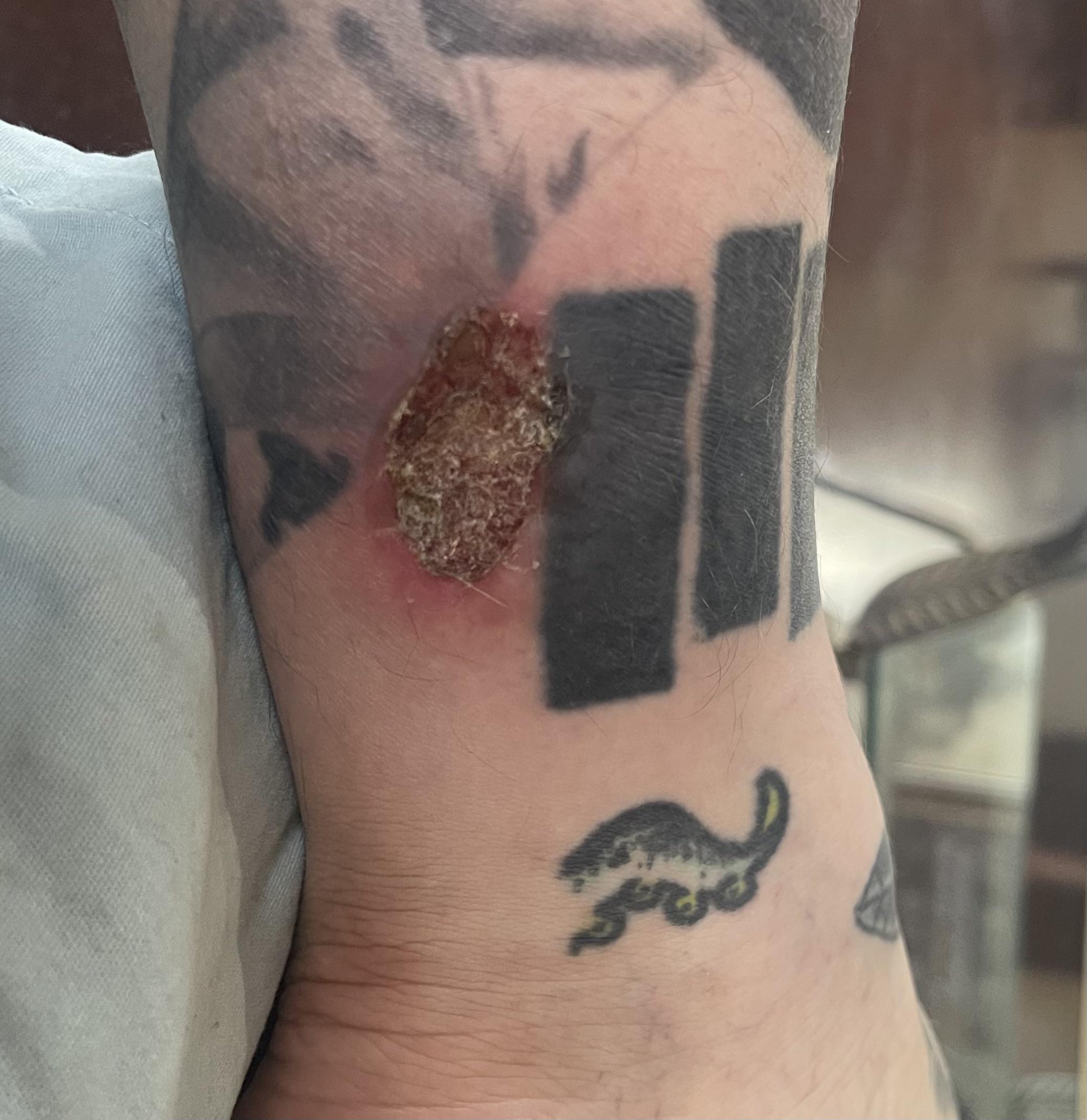 Nitrous tank burn r/NitrousOxide