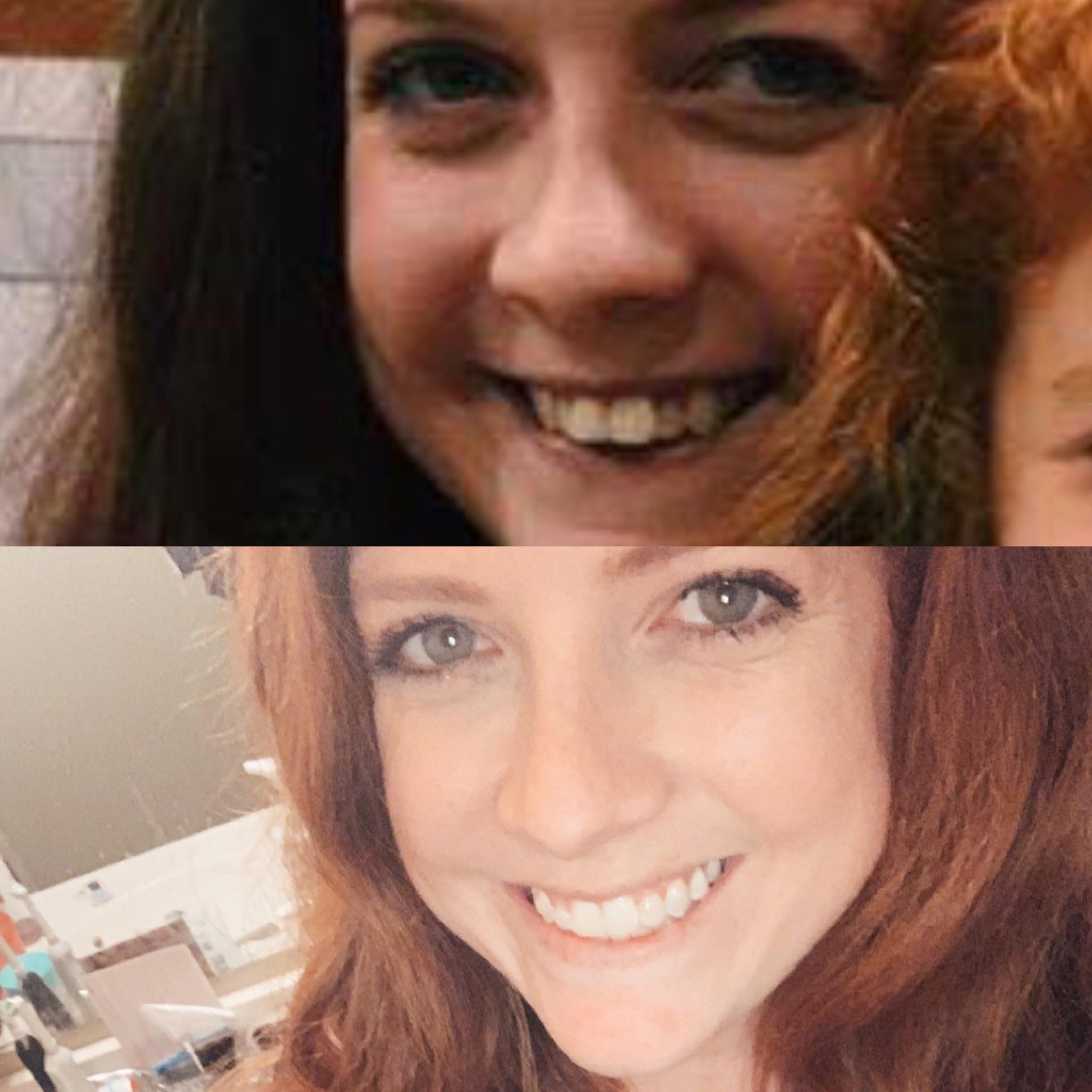 55 trays. Currently 12 more refinements. Newly, Elastics at night. r/Invisalign