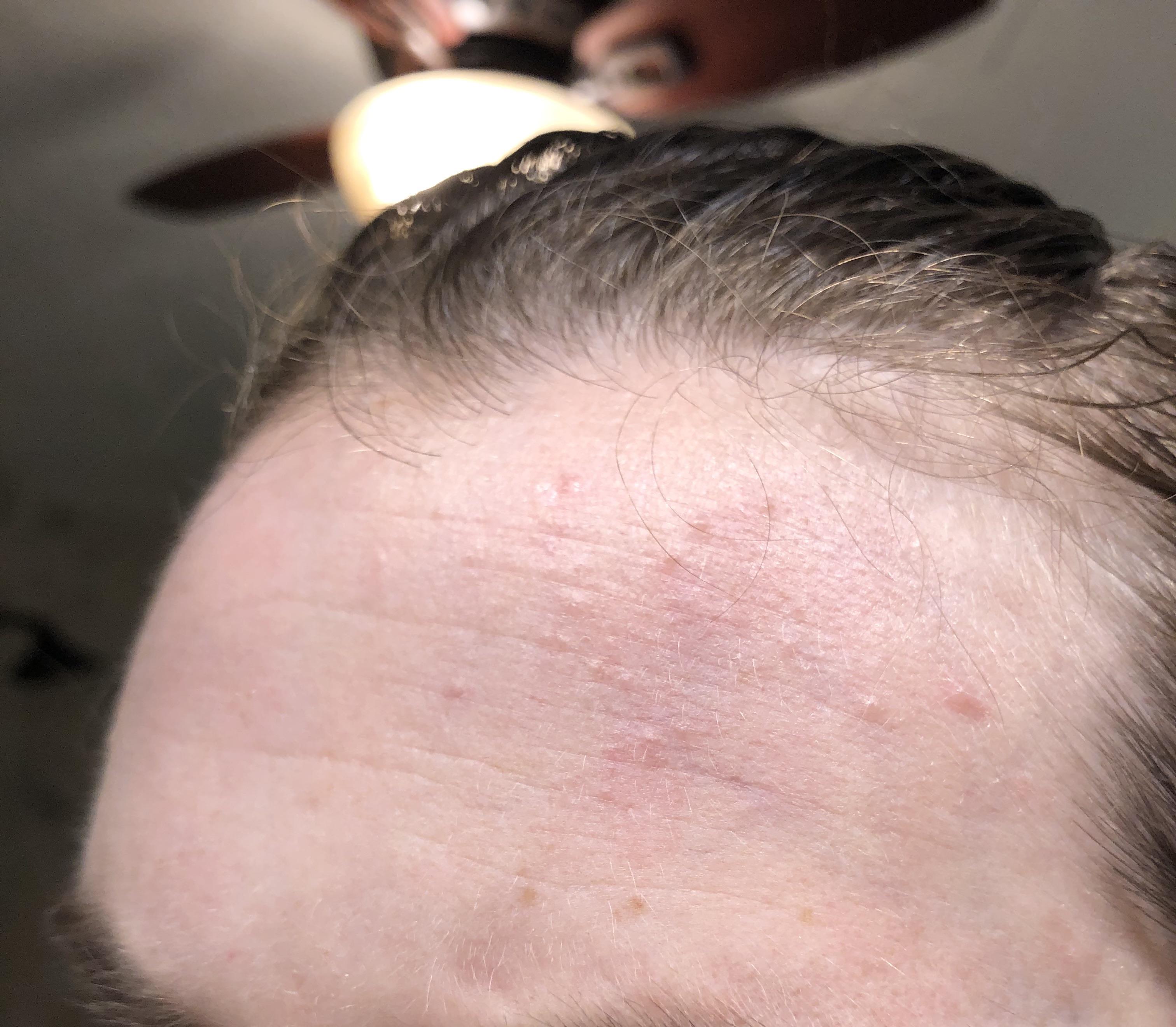 Help! Is this fungal acne? At a loss with what to do. It keeps