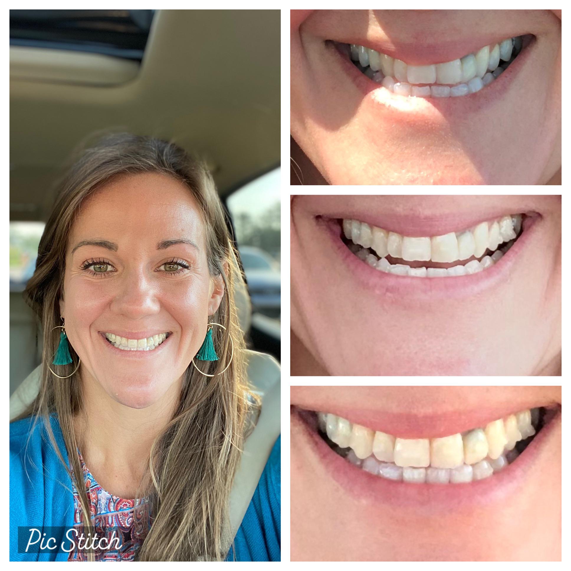 For my fellow mild underbite / crossbite friends who have considered