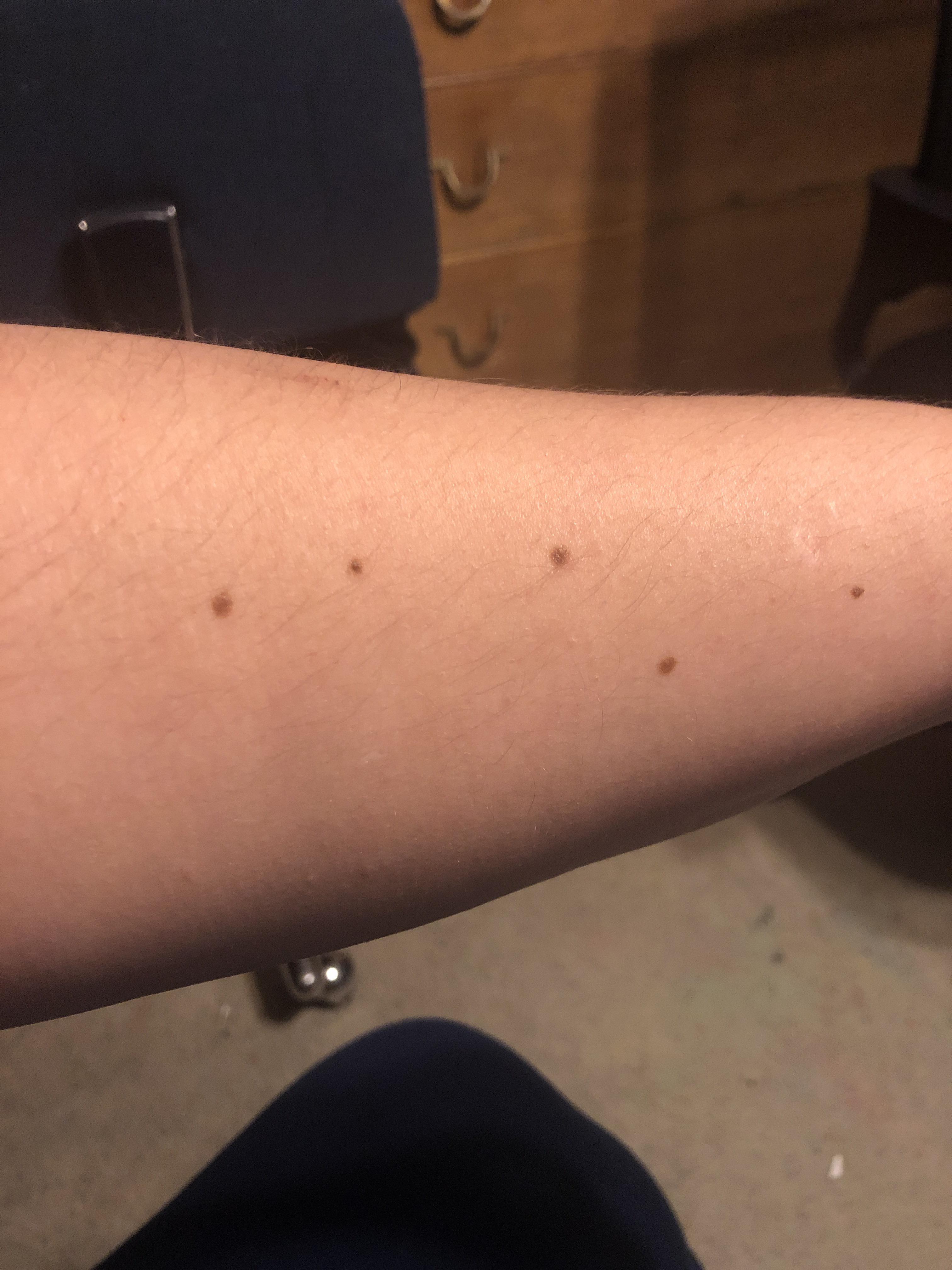 The birthmark on my arm looks like a famous constellation. r