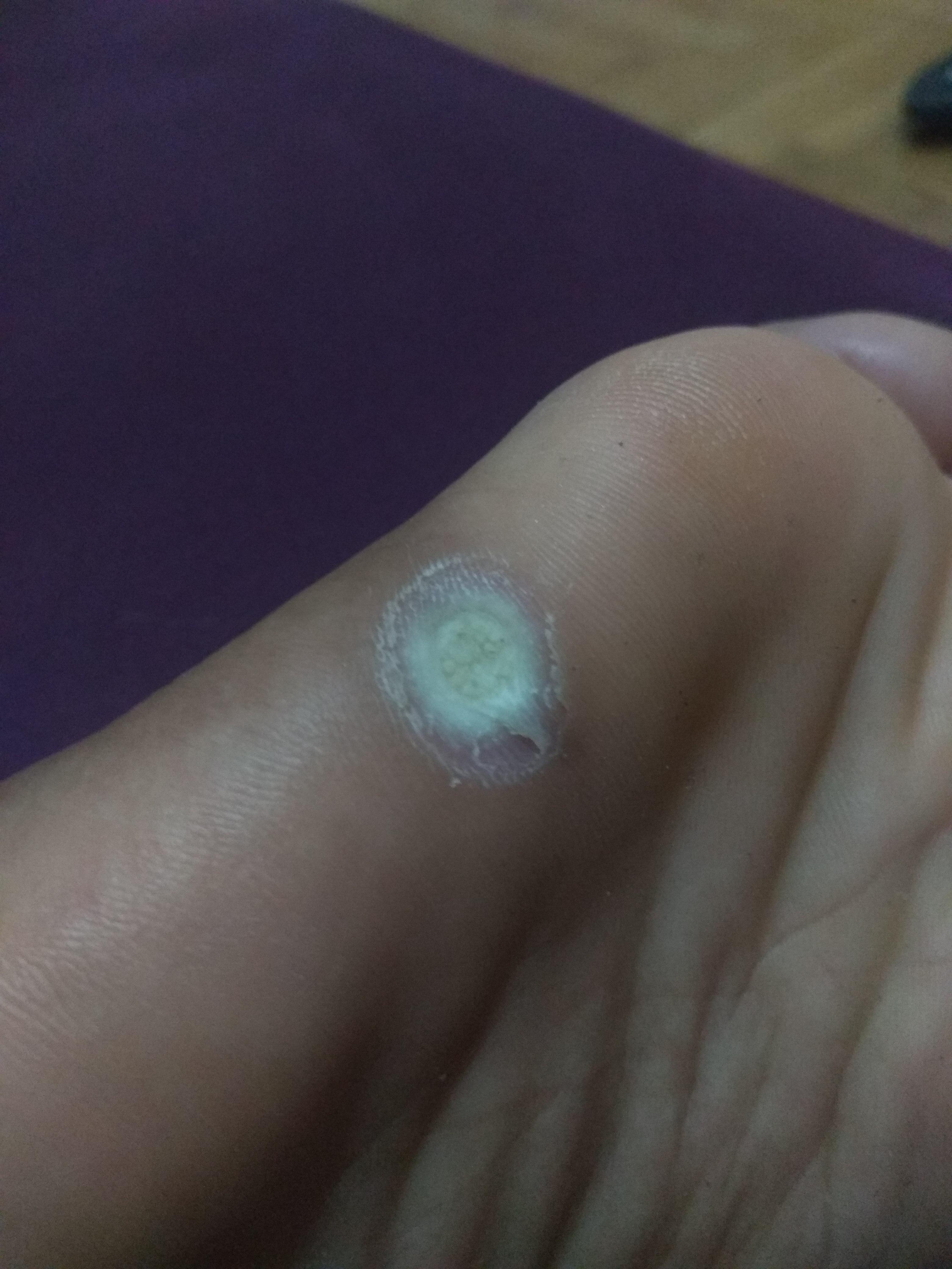 Most Perfect Will A Planters Wart Go Away Ideas