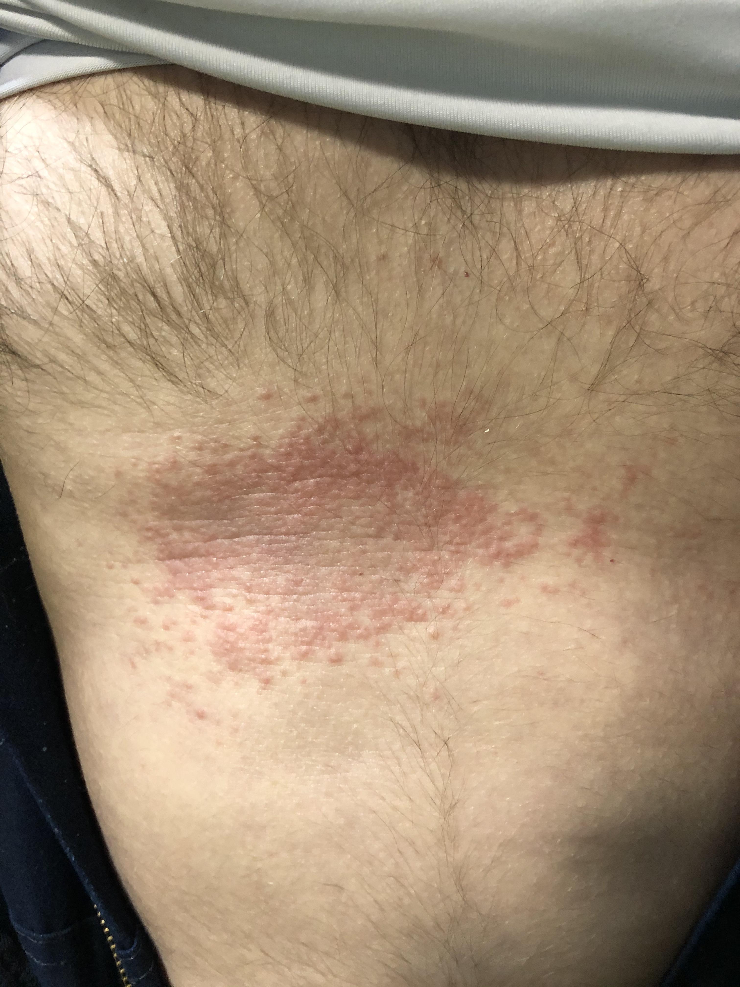 Itchy Rash On Upper Chest
