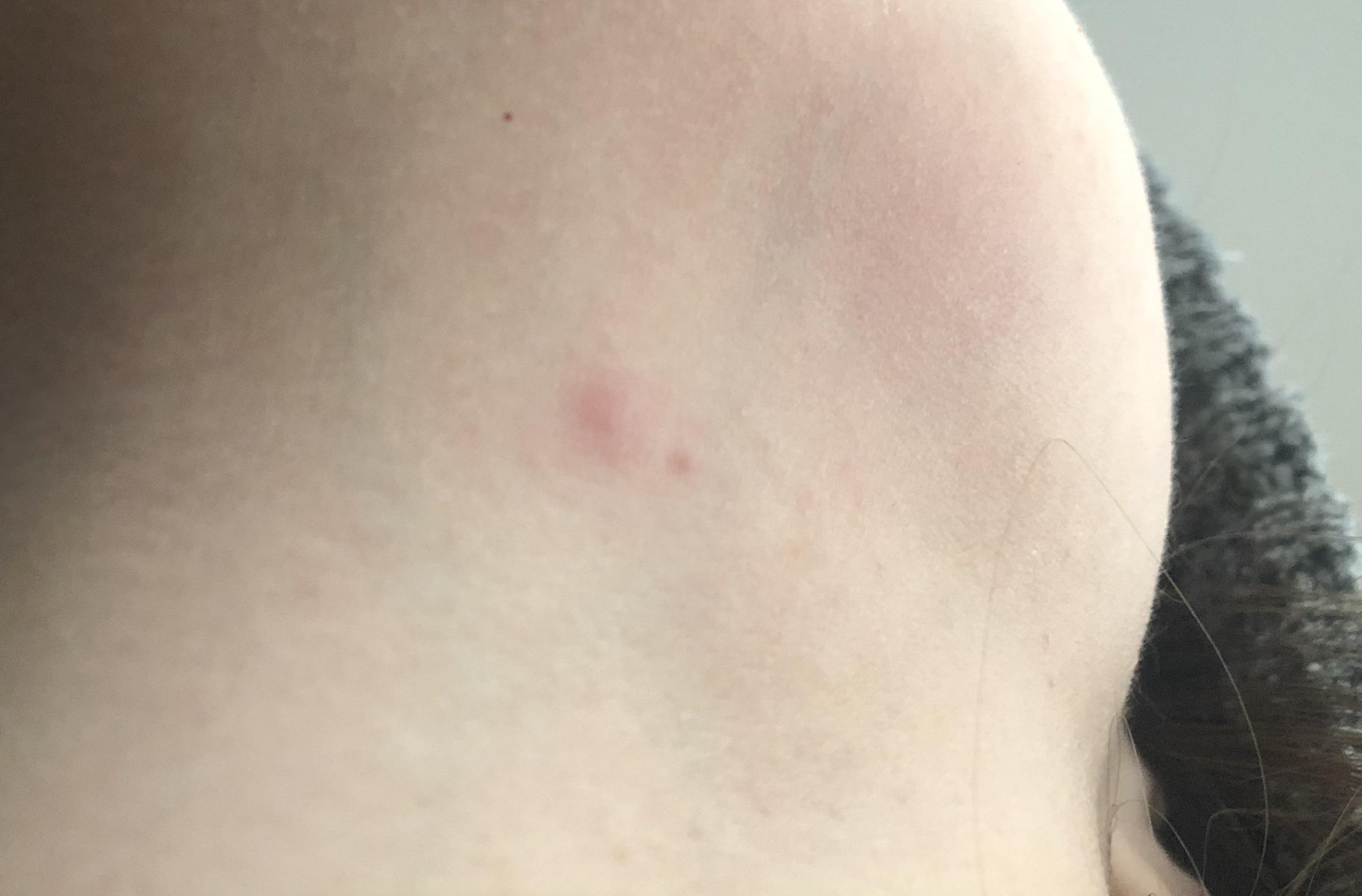 Been getting itchy red bumps on my neck more frequently lately. Hives