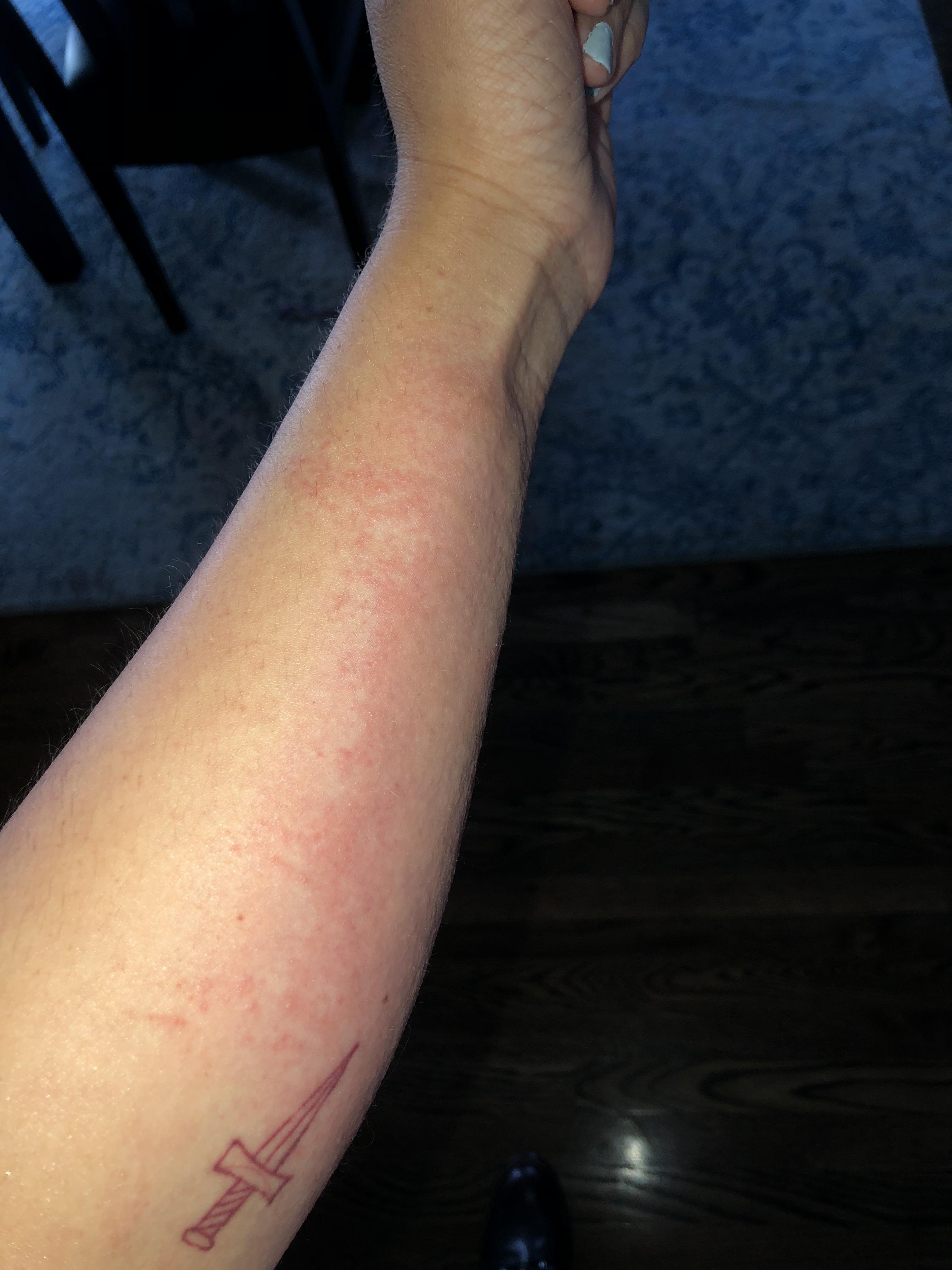 Poison ivy has only gotten worse. On third day of oral steroids, but