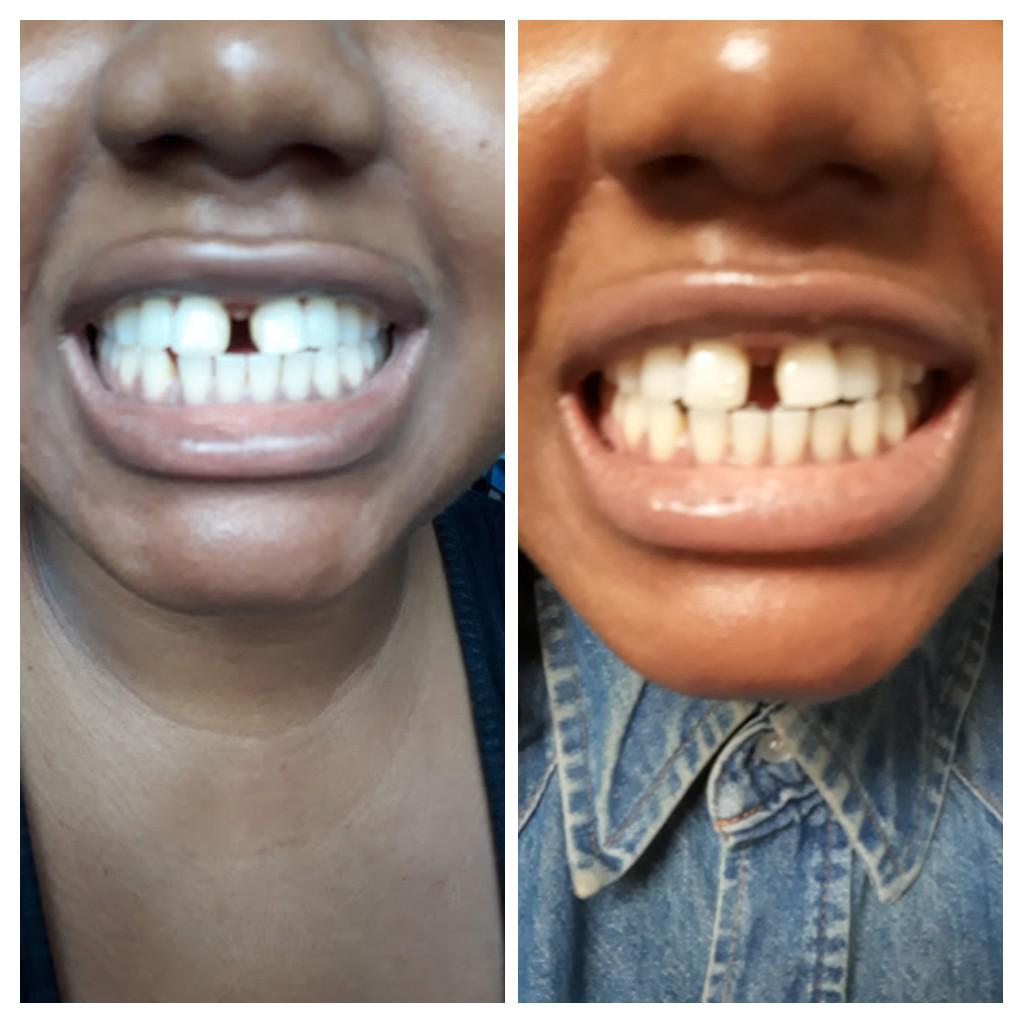 L; before braces R; 2 weeks 2 day progress with Inbrace lingual braces