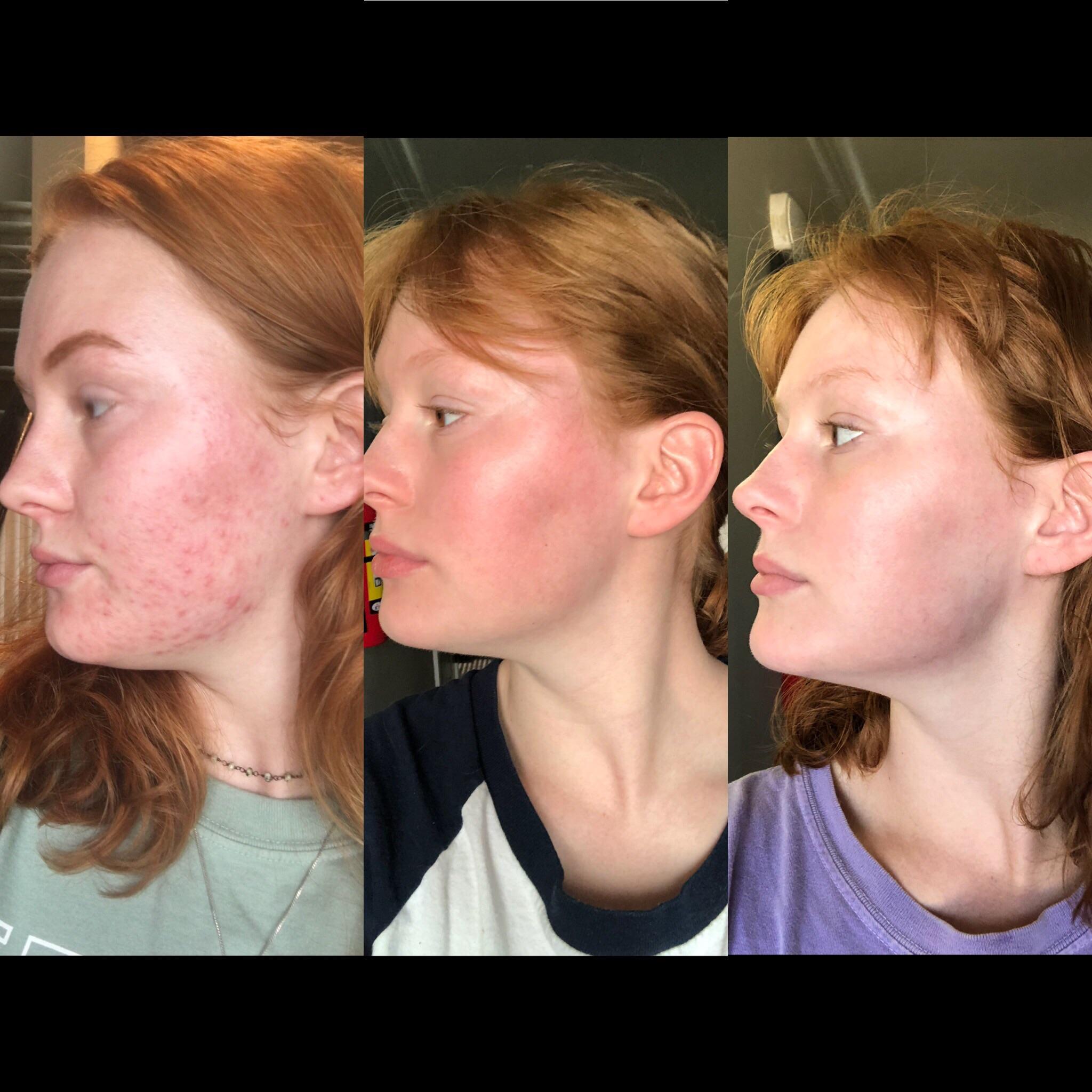 First day, last day, and 1 month post accutane. I couldn’t be happier!! The facial flushing was