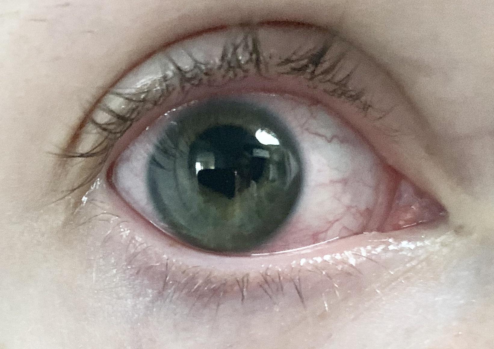 My iris got so inflamed it got “sticky” and I had to use eye drops to