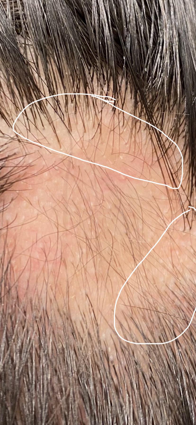 These hairs on the the bald spot are extremely thinner than the other