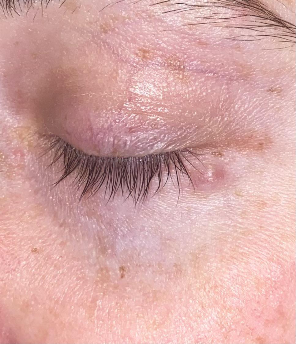 Small lump under my eye since January. Been to multiple Dr’s and no
