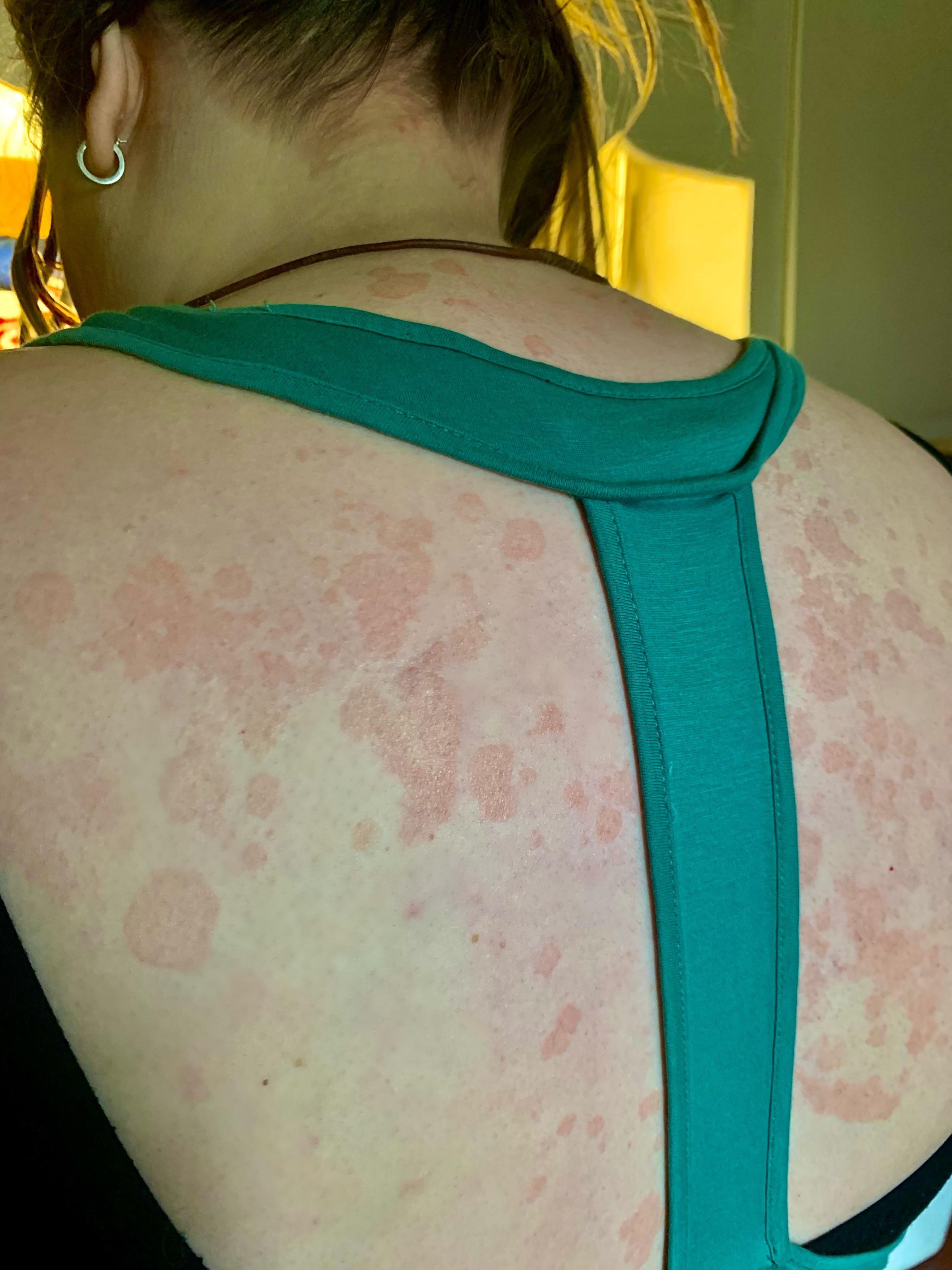 What is it?This rash has been on and off for about a year. Doctor says