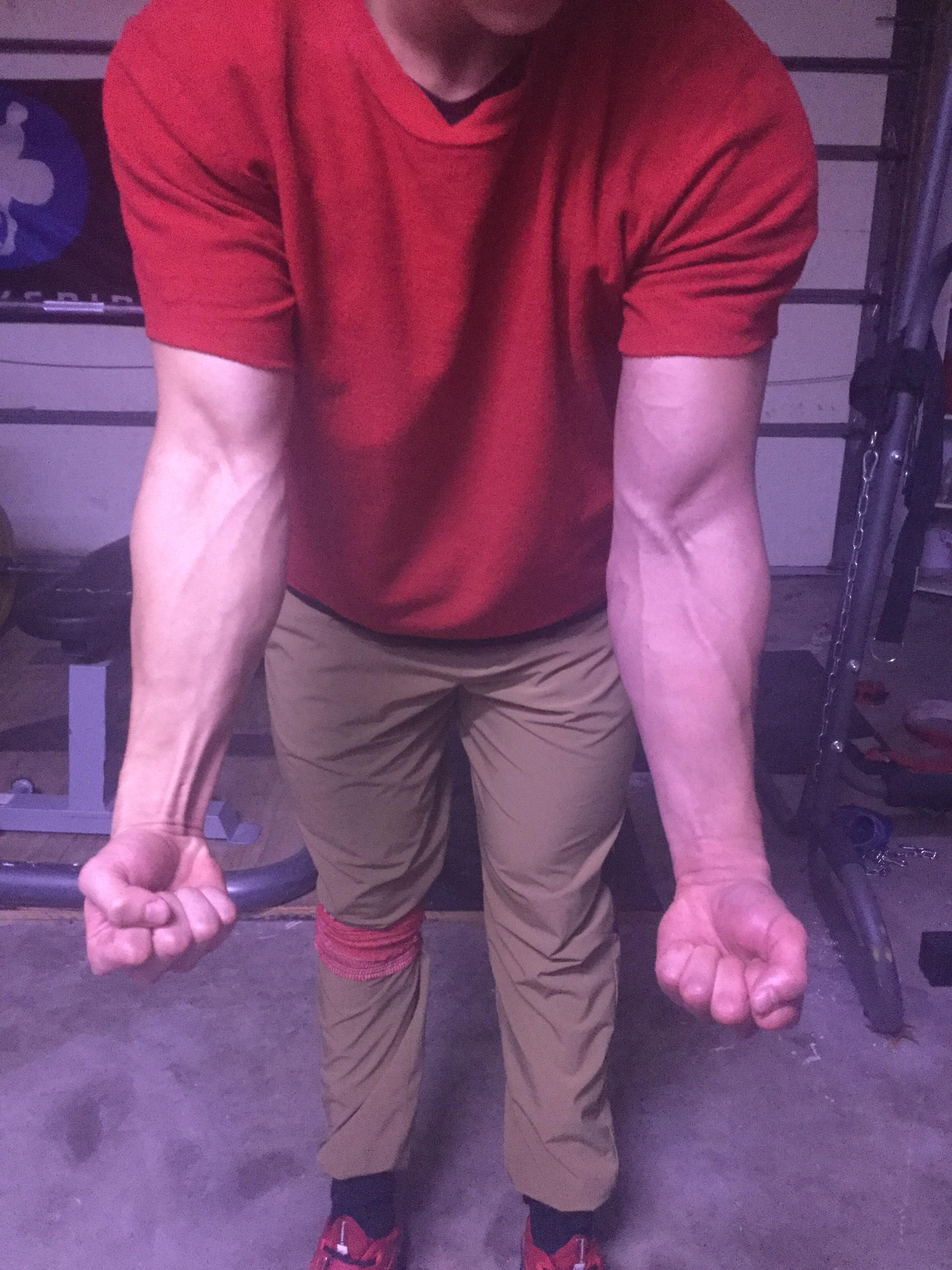 Upper Extremity Deep Vein Thrombosis