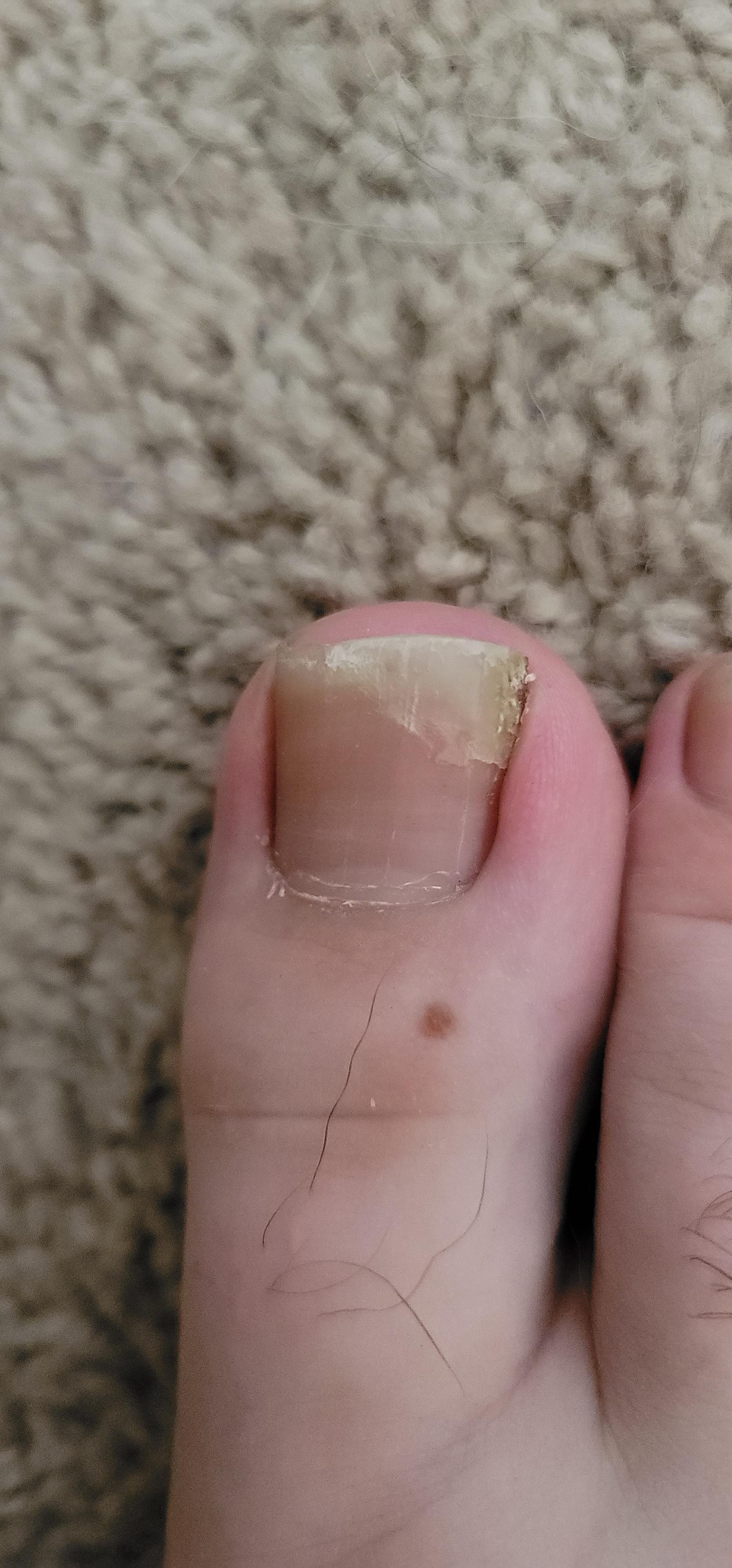 I just tripped going up my stairs and almost ripped my toenail off