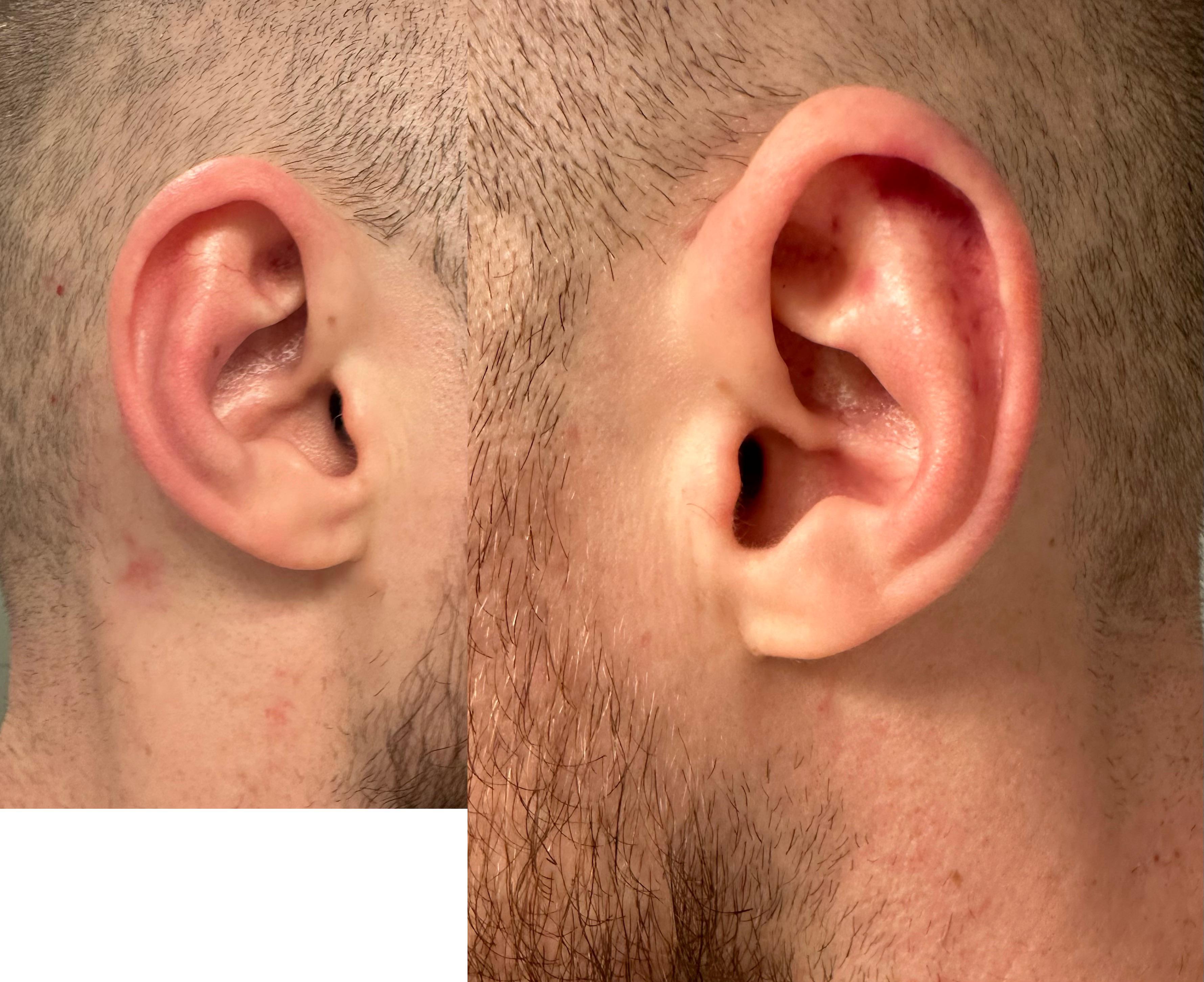 Early stages of cauliflower ear? r/wrestling
