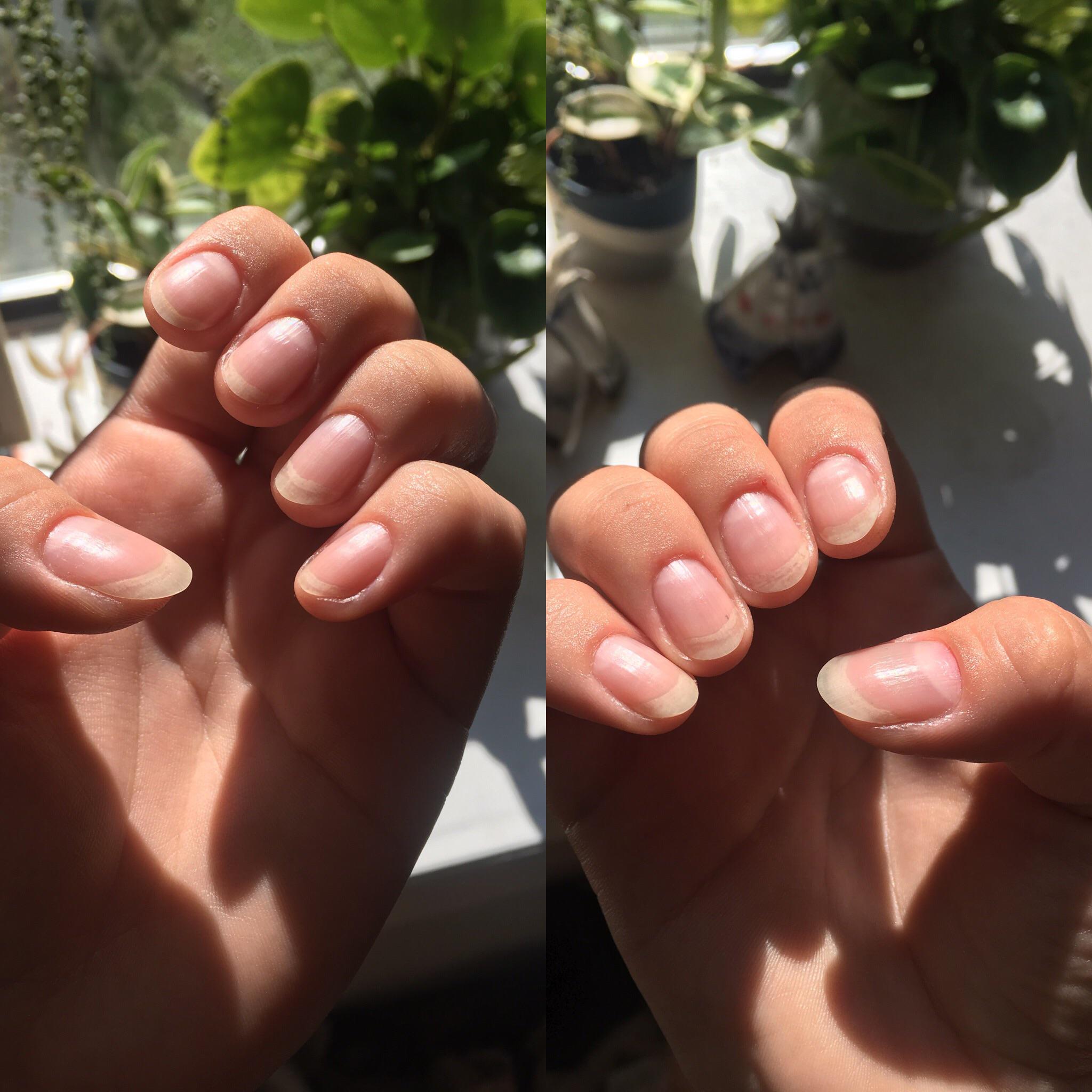 Picking my nails has been one of my anxiety coping mechanisms for as