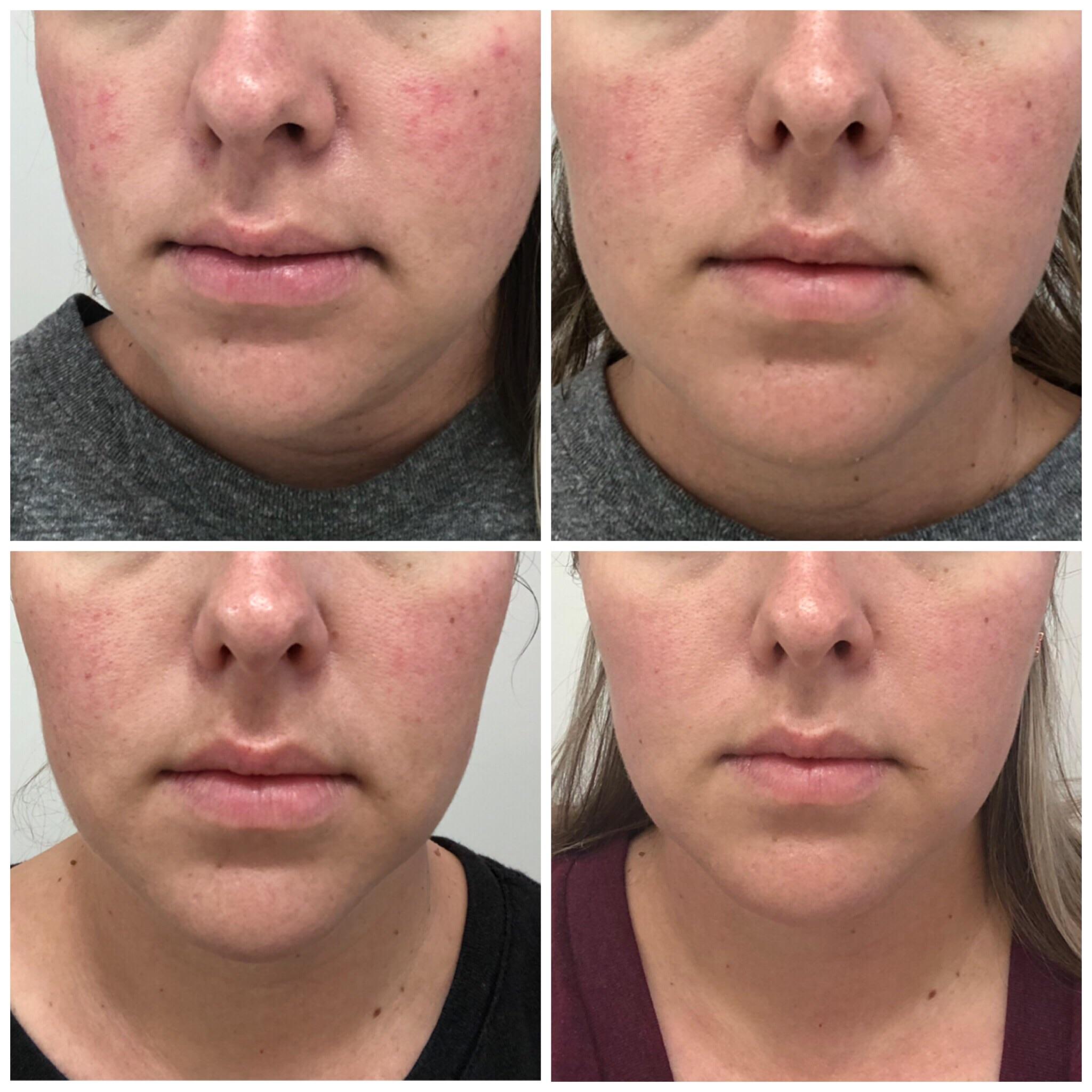 Using Clinique redness solutions 1 month r/Rosacea