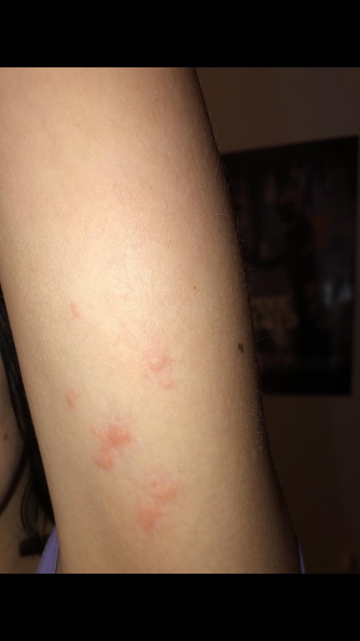 What are these bites?? I keep waking up with these bites, and I’m sure