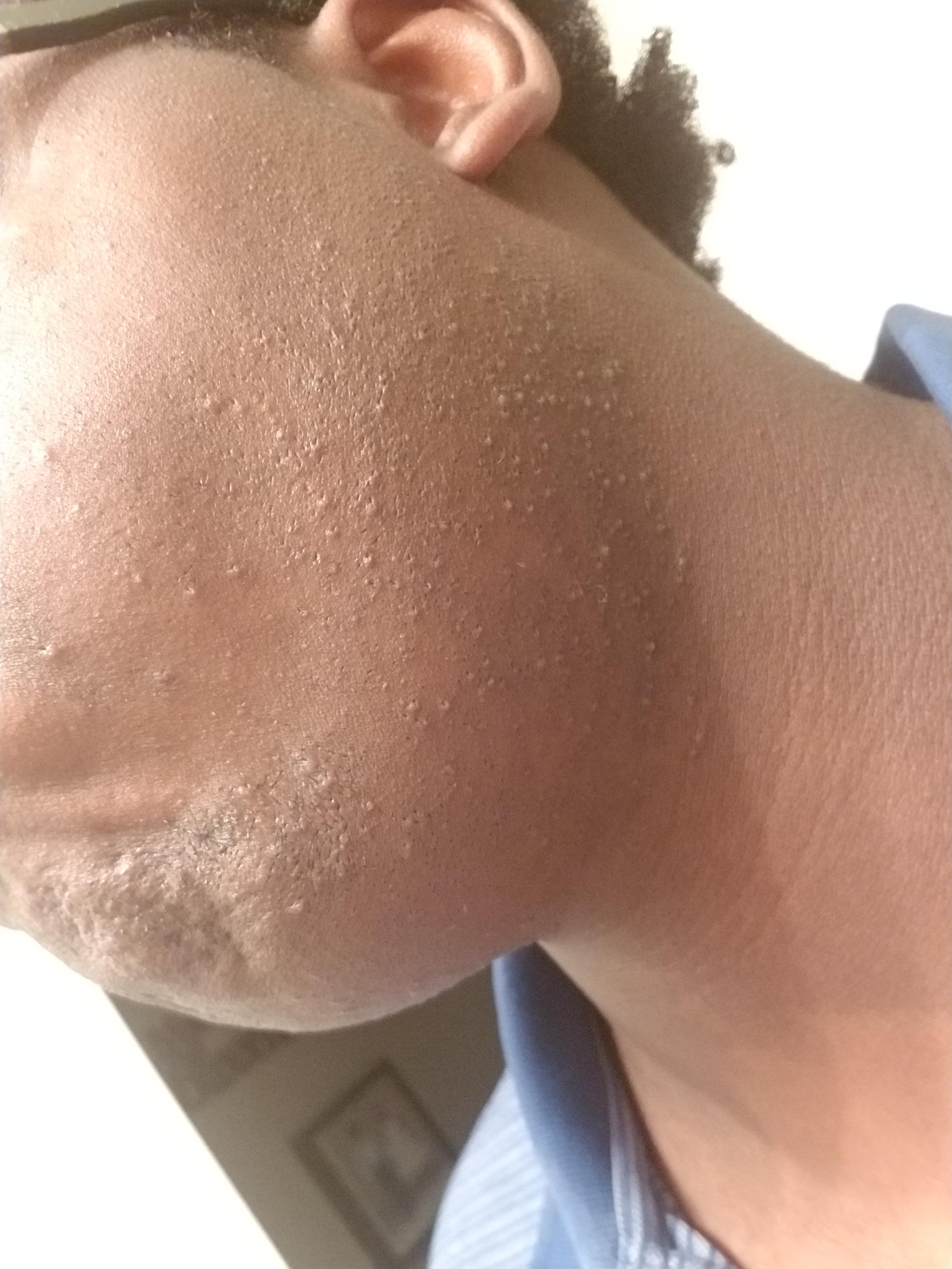 Discover 66+ ingrown hair razor bumps best in.eteachers