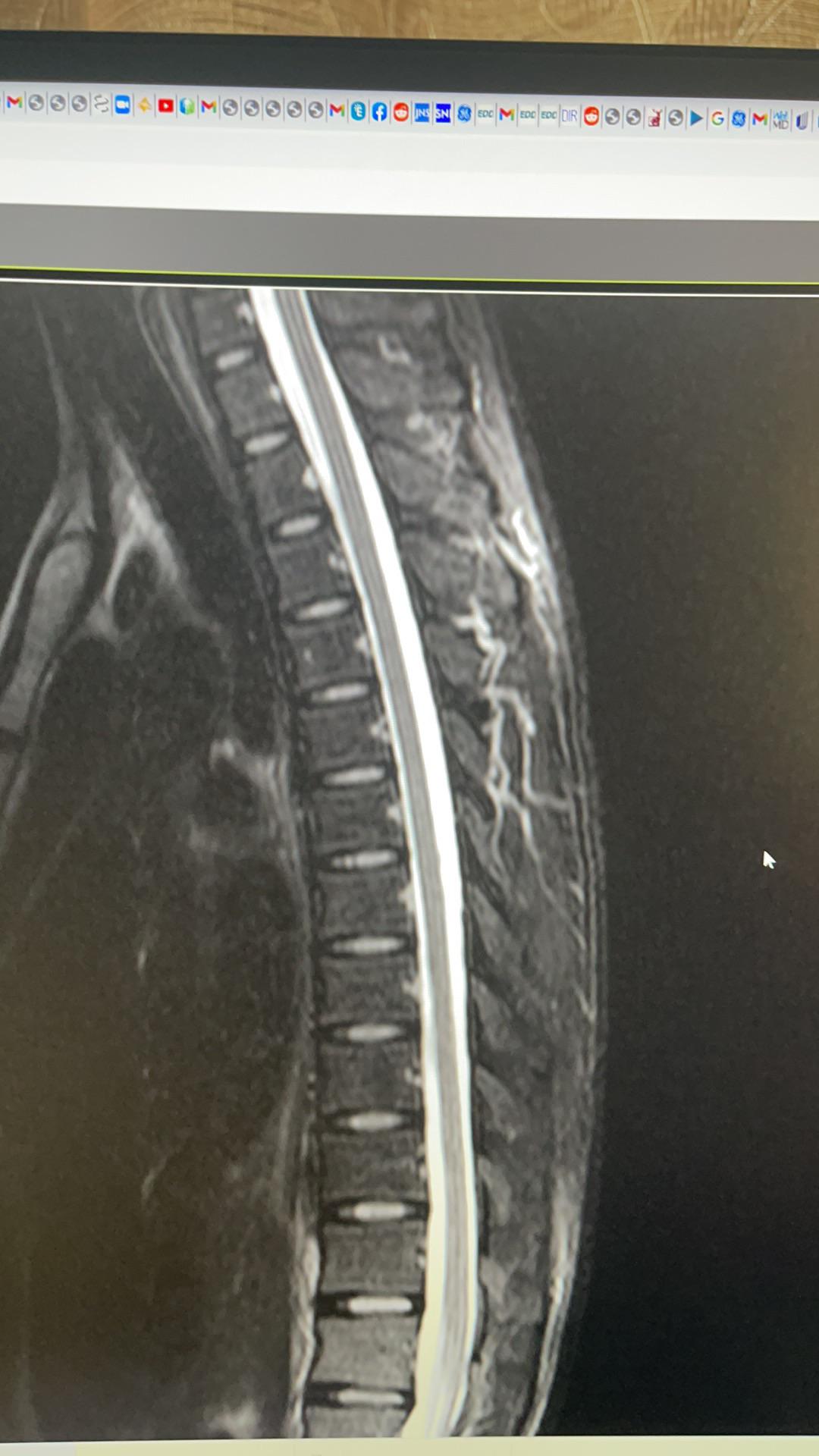 Thoracic muscle spasms and back pain, MRI shows mild degenerative