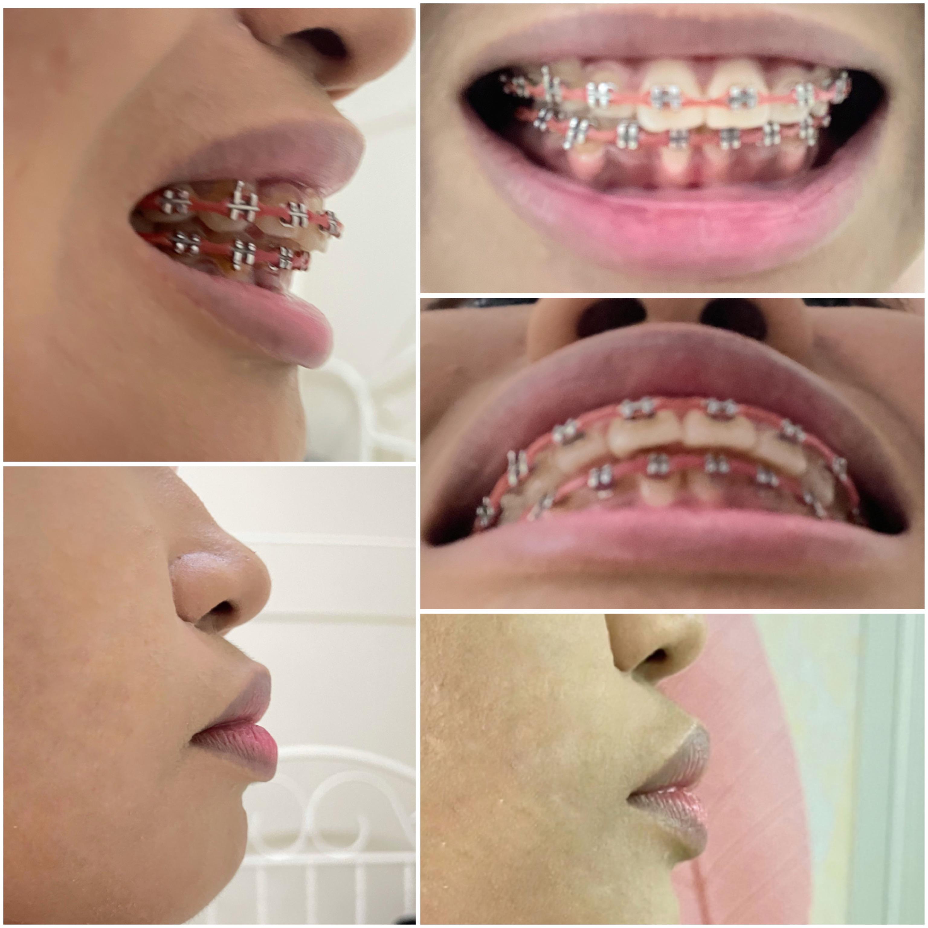 One year four months progress. My orthodontist ask me to decide if I