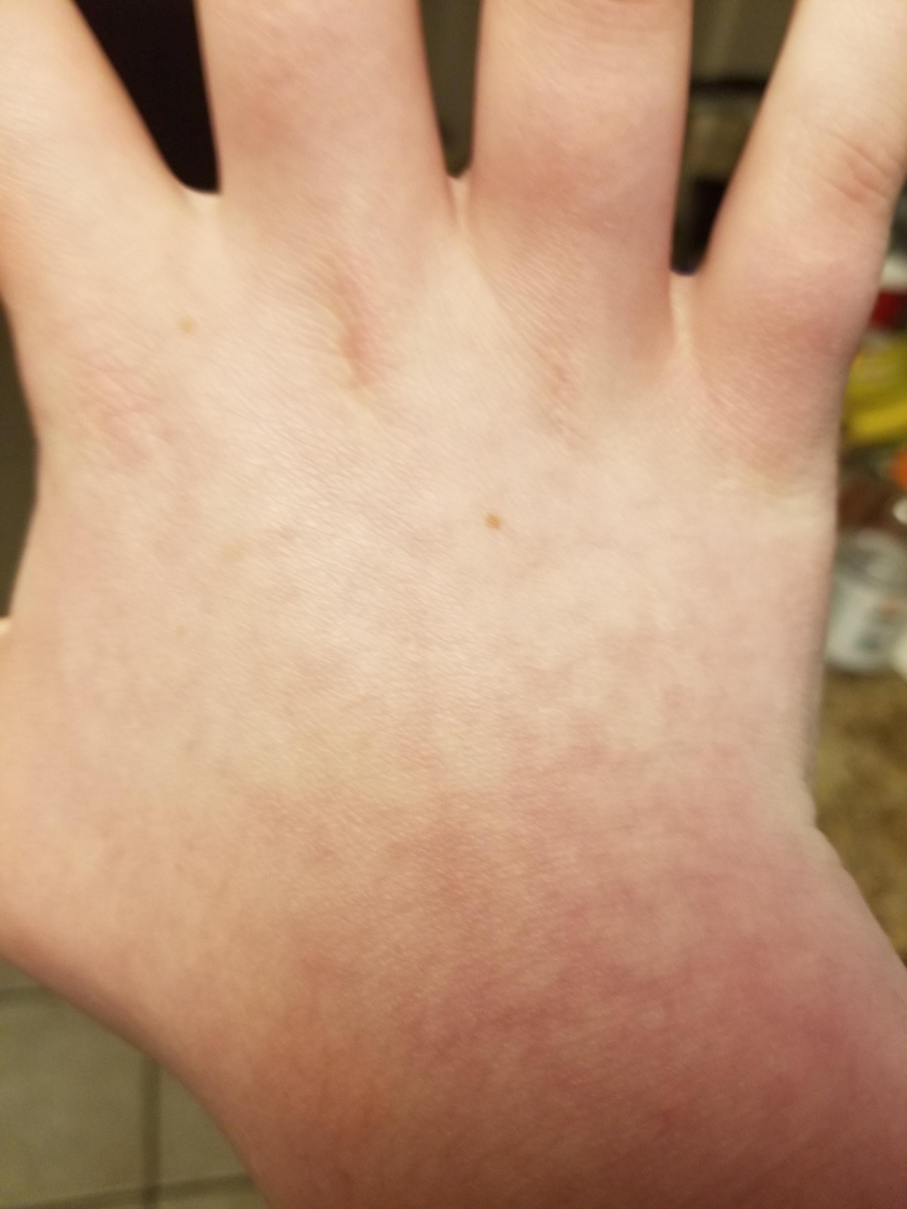 3 months after sepsis and I still get mottled skin and limbs that never