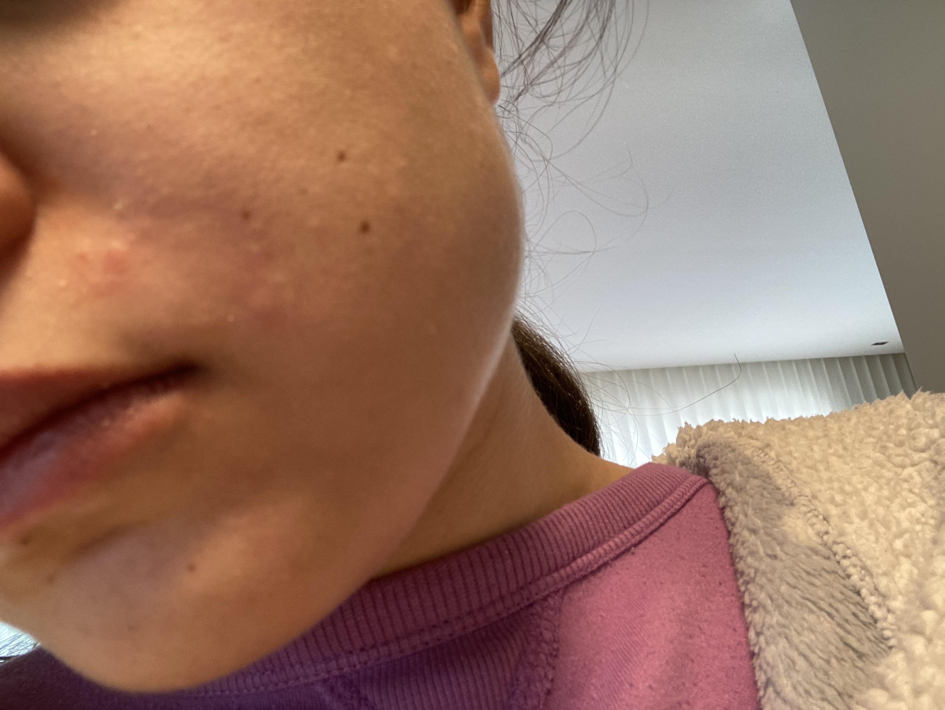 [Skin Concerns] Visible bumps around mustache area, what can I do to