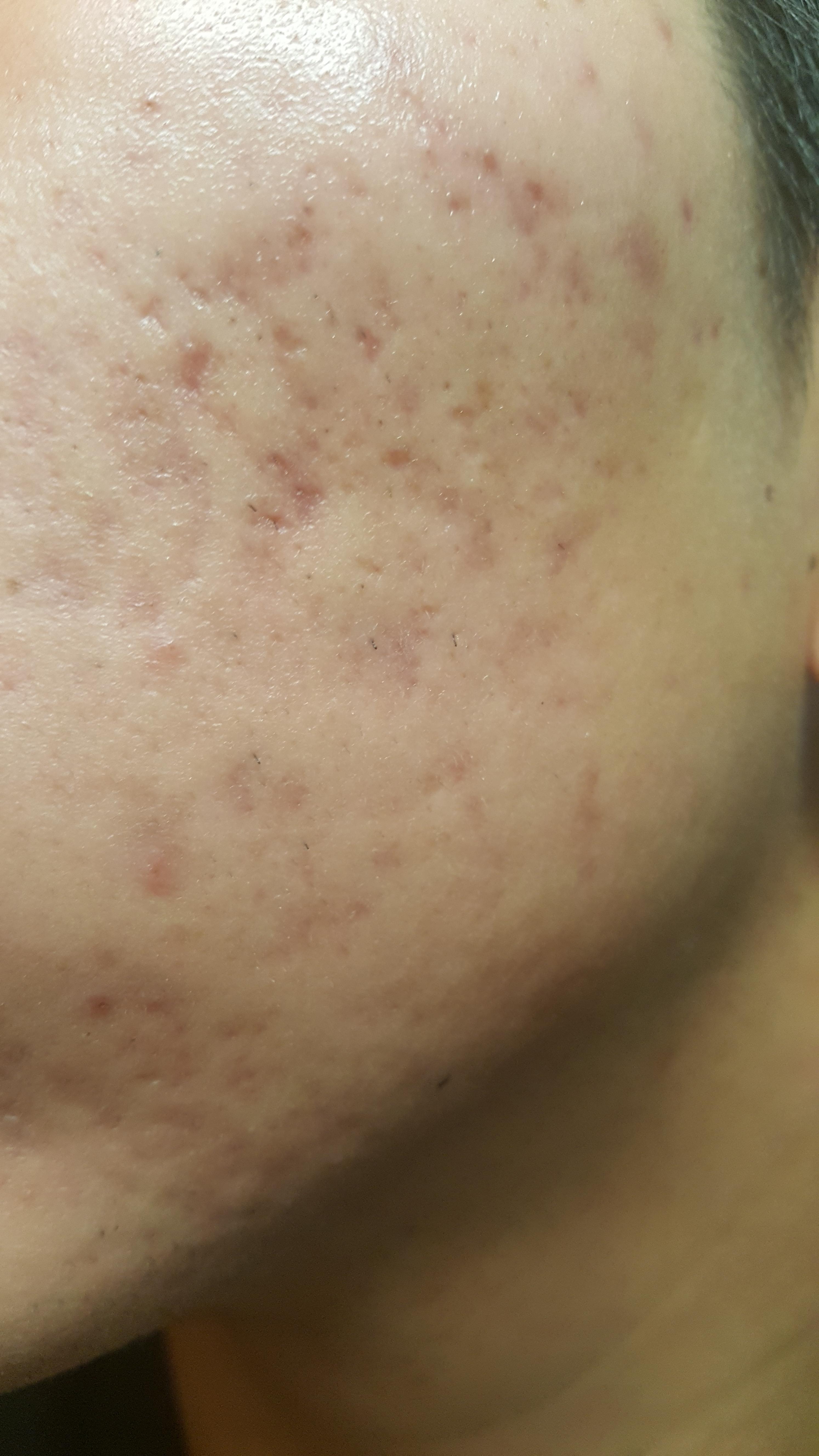 [Skin Concerns] PIH or PIE treatment help r/SkincareAddiction