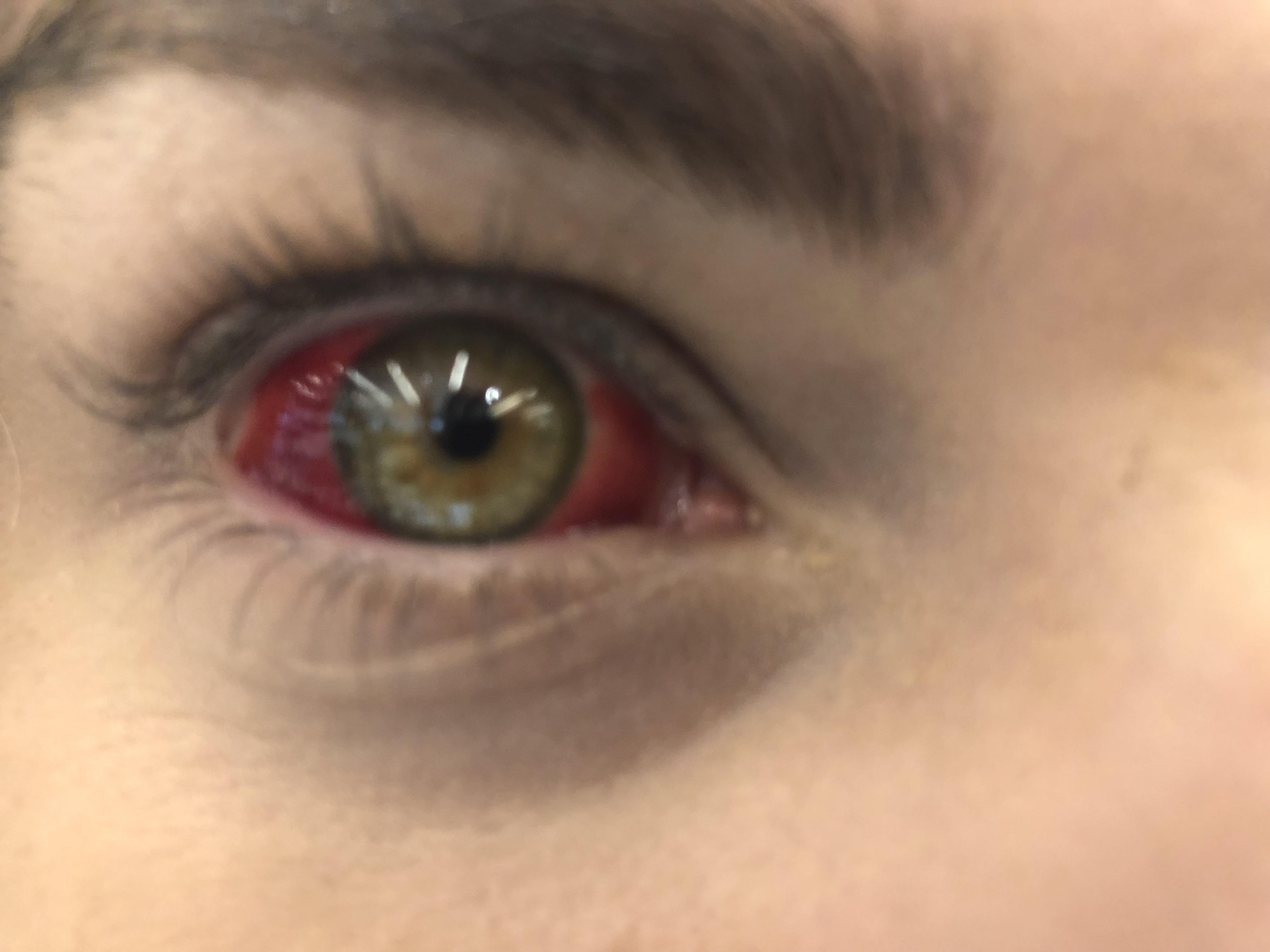 My friend has a burst blood vessel in her eye 😱 r/eyes
