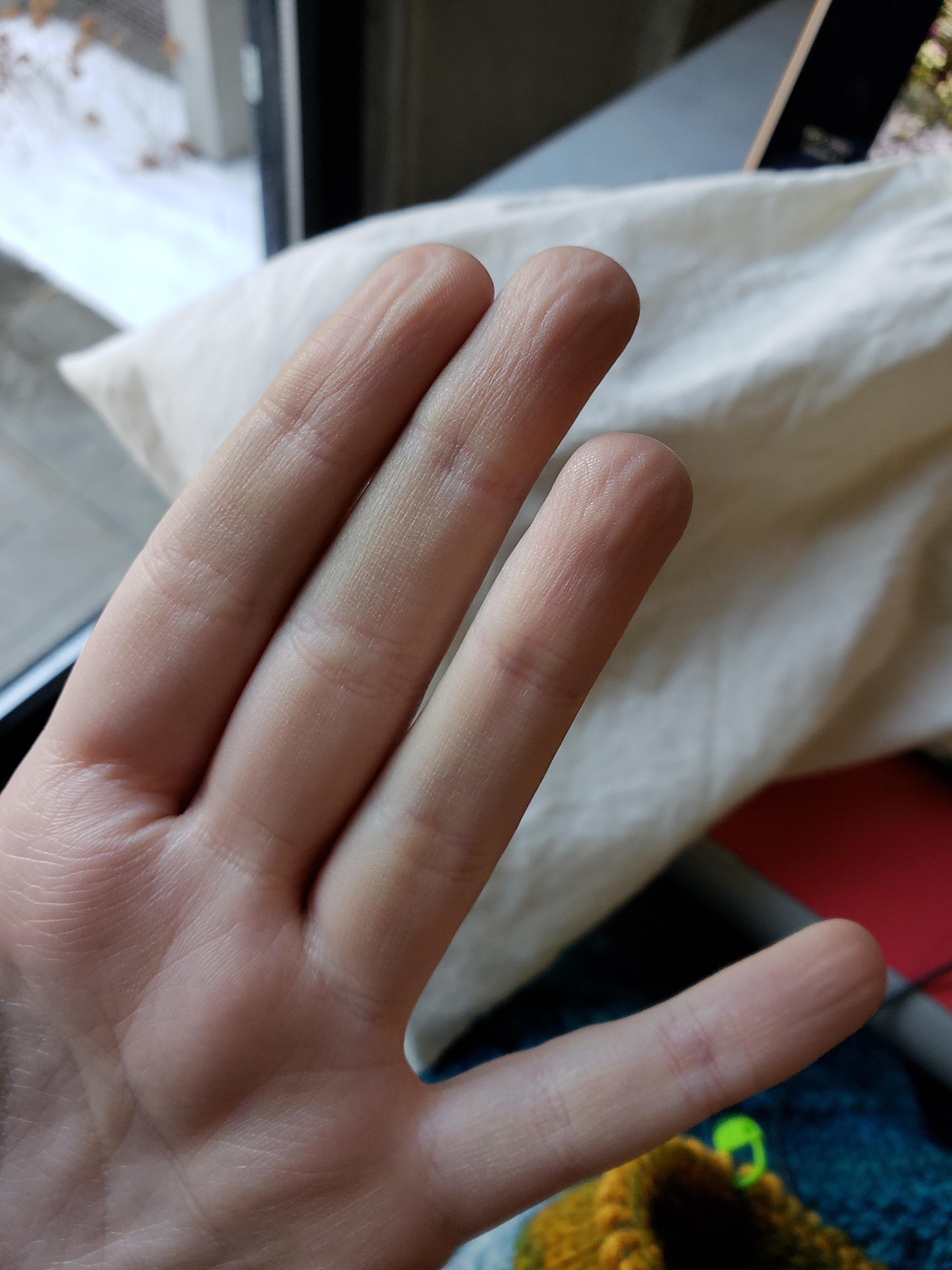 Do your fingertips look like this after knitting for a while? Why? r