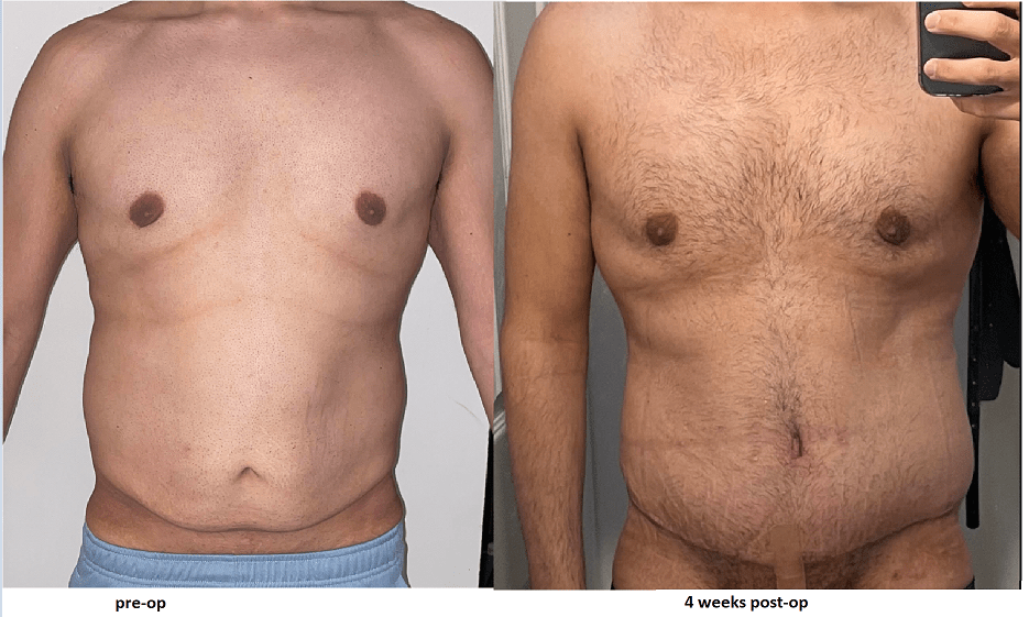 4 weeks postop, male tummy tuck. Did anyone have similar swelling on