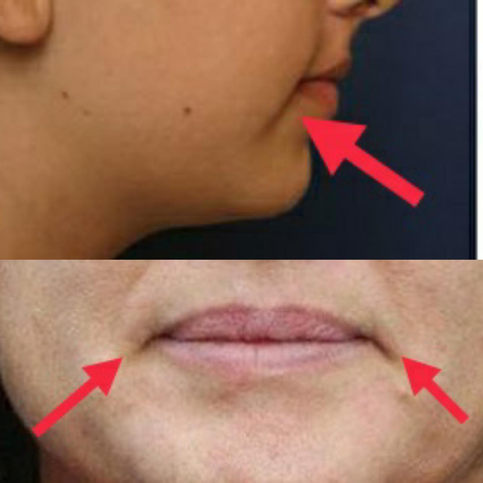 What to do against puffy cheeks ? r/orthotropics